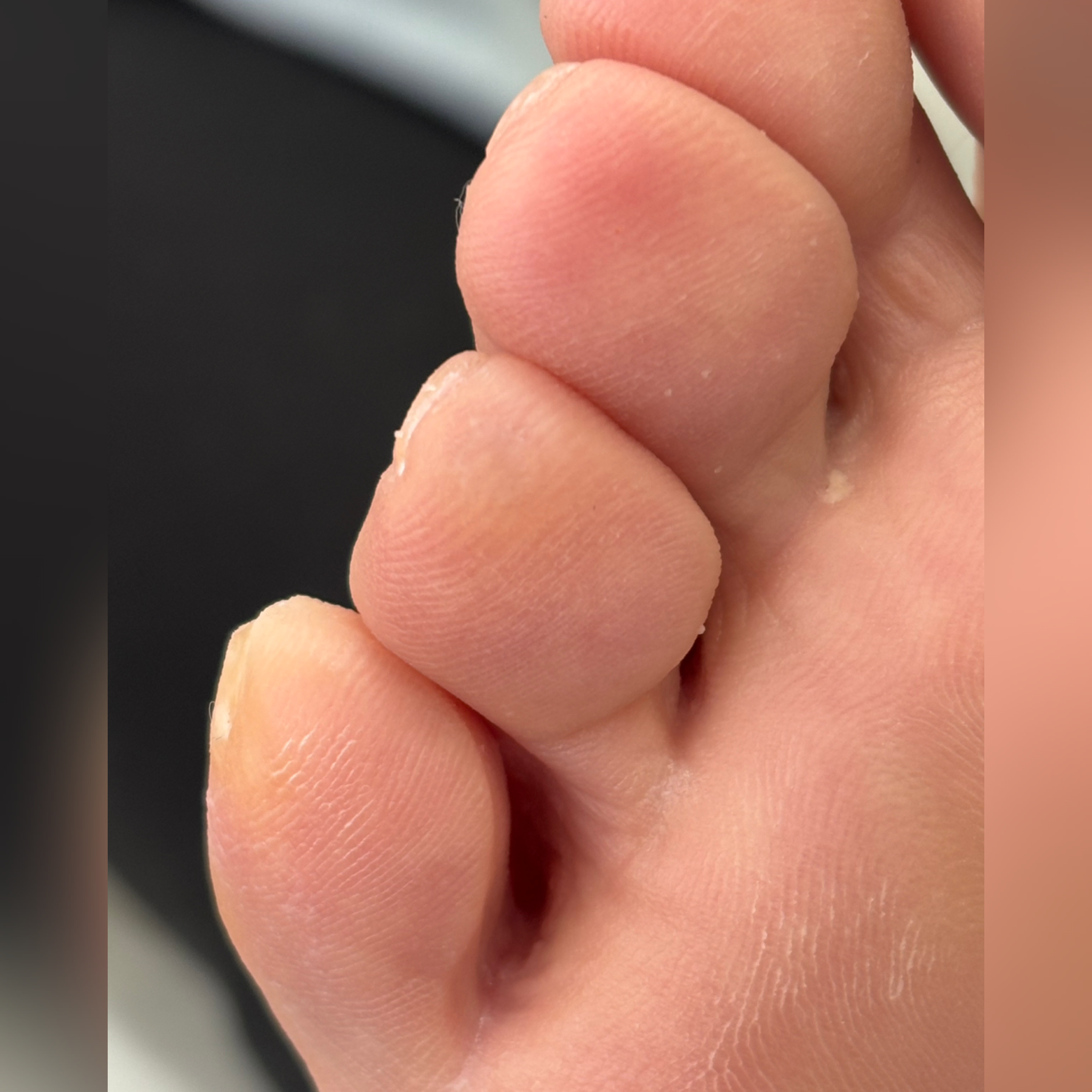 Обработка мозоли. Подолог г. Хабаровск — центр здоровой стопы «FOOTTIME»