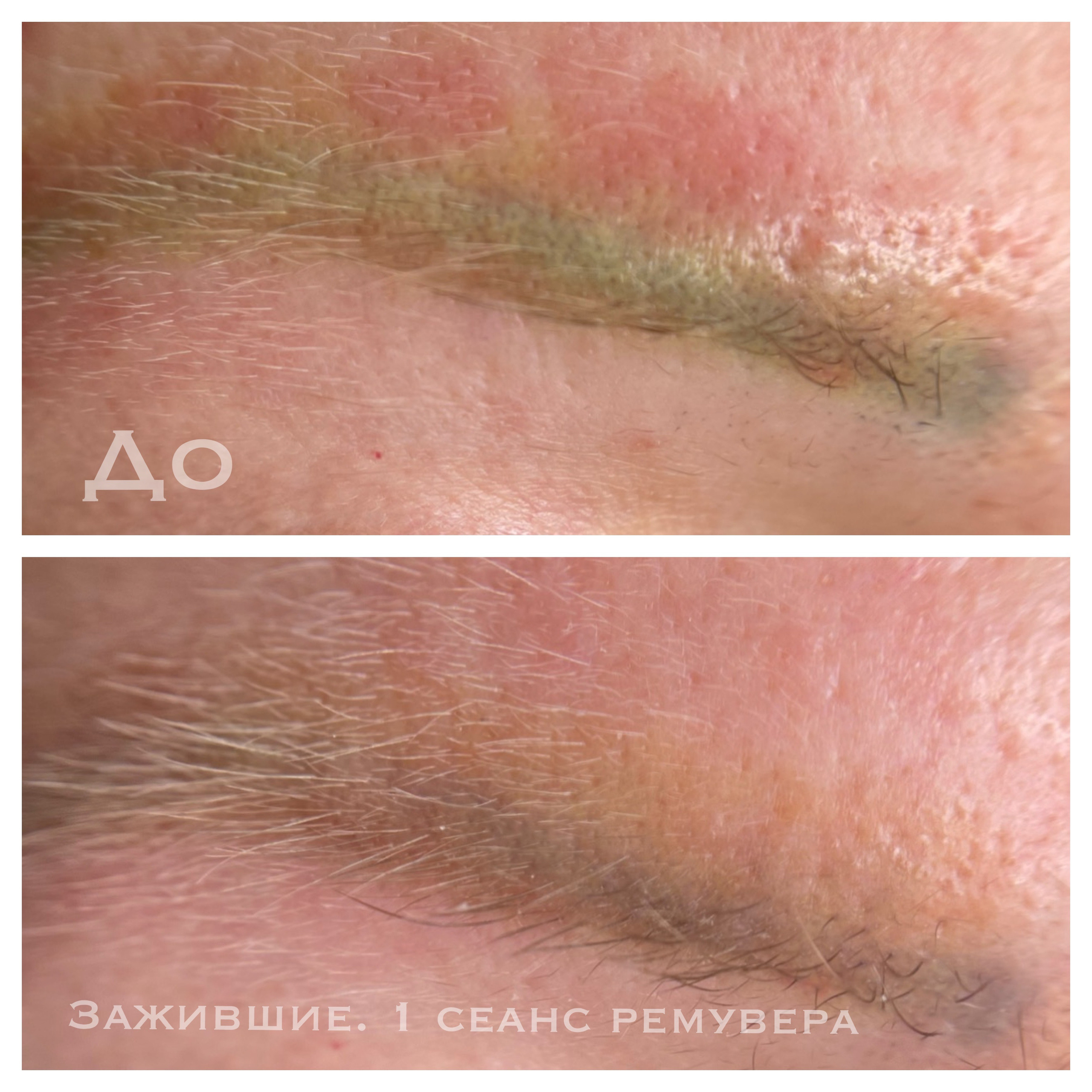 УДАЛЕНИЕ СТАРОГО ТАТУАЖА. Перманентный макияж и удаление старого татуажа в Ростове-на-Дону Дарья Исакова