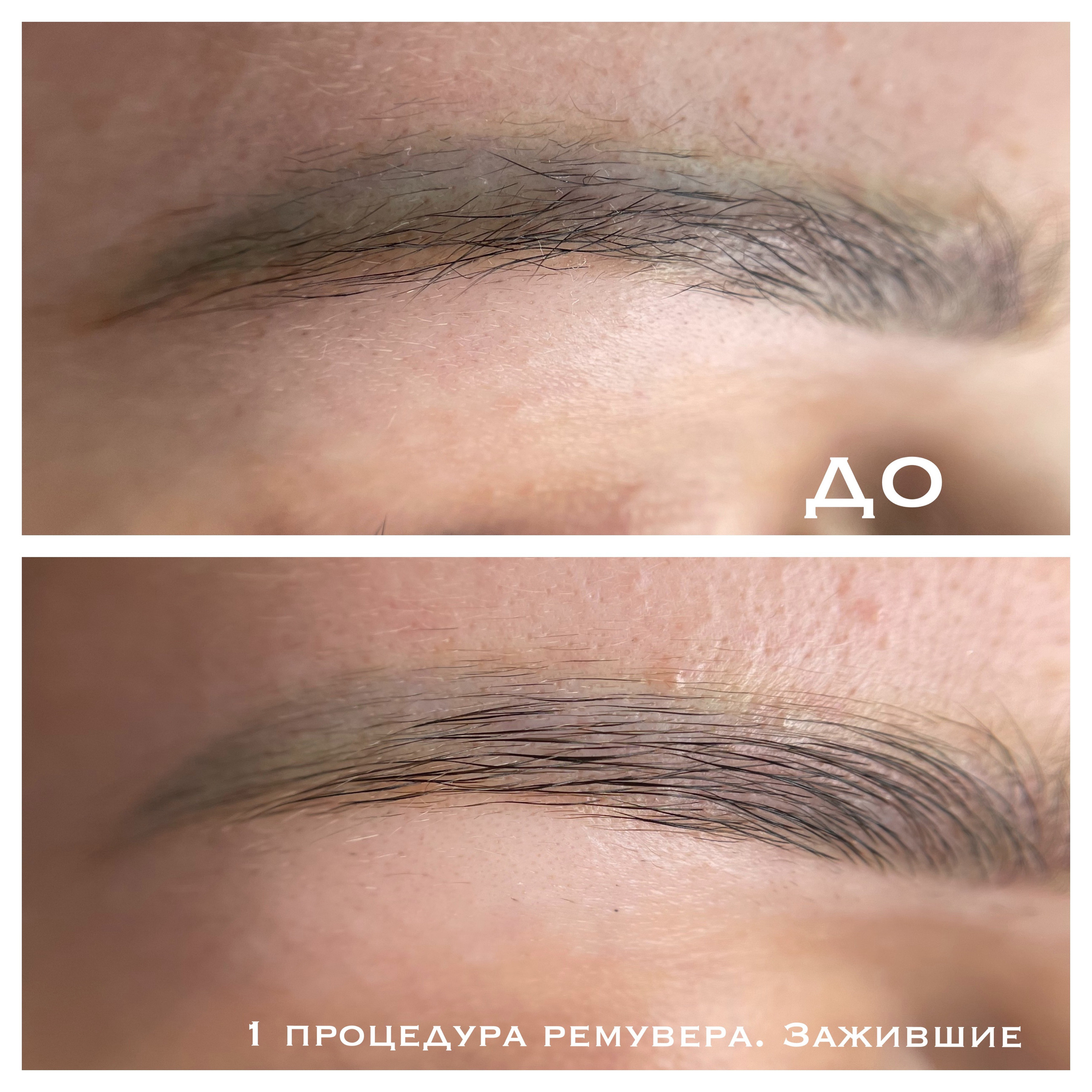 удаление некачественного татуажа бровей ремувером в Ростове-на-Дону