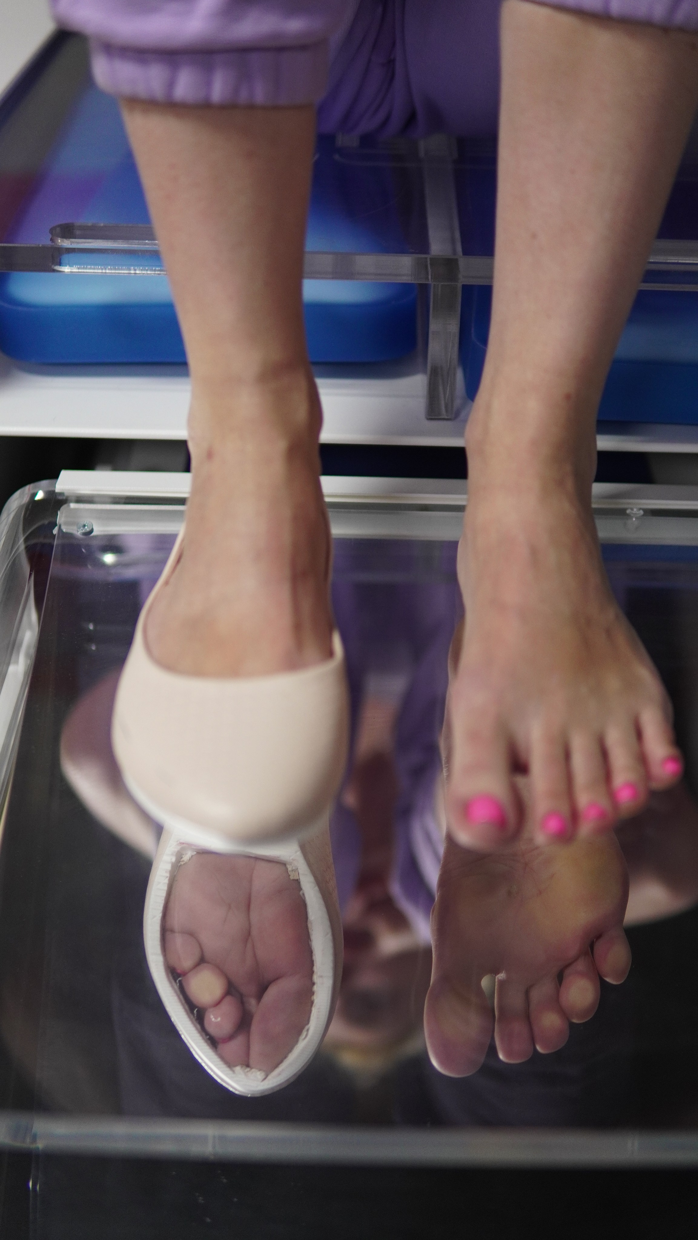 деформация стопы от обуви неправильная обувь вред плоскостопие косточка на ноге