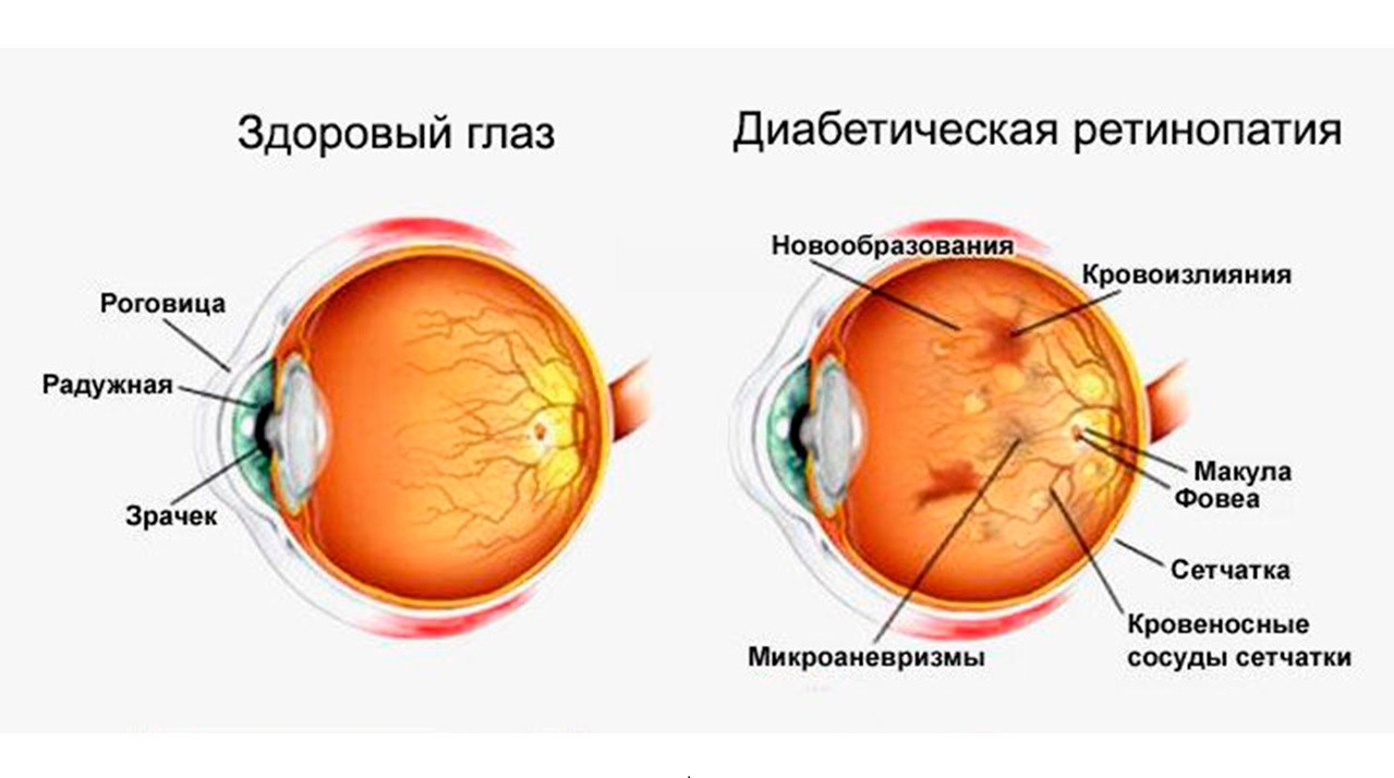 Диабети́ческая ретинопати́я&nbsp; - какие препараты компании Сово-Сова рекомендуются