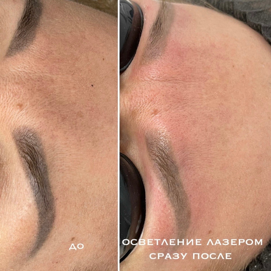 Удаление бровей лазером 