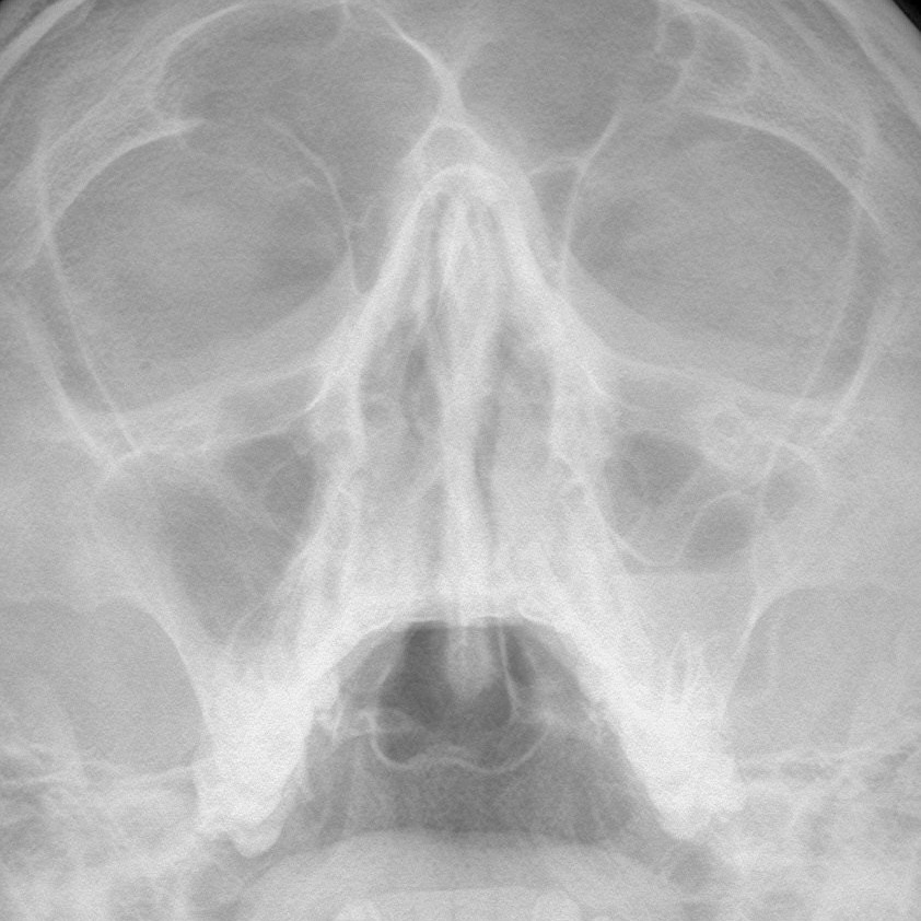 Разбираемся с пазухами на рентгене. Первые шаги. РЕНТГЕН КТ МРТ в Санкт-Петербурге Александра Лоншакова