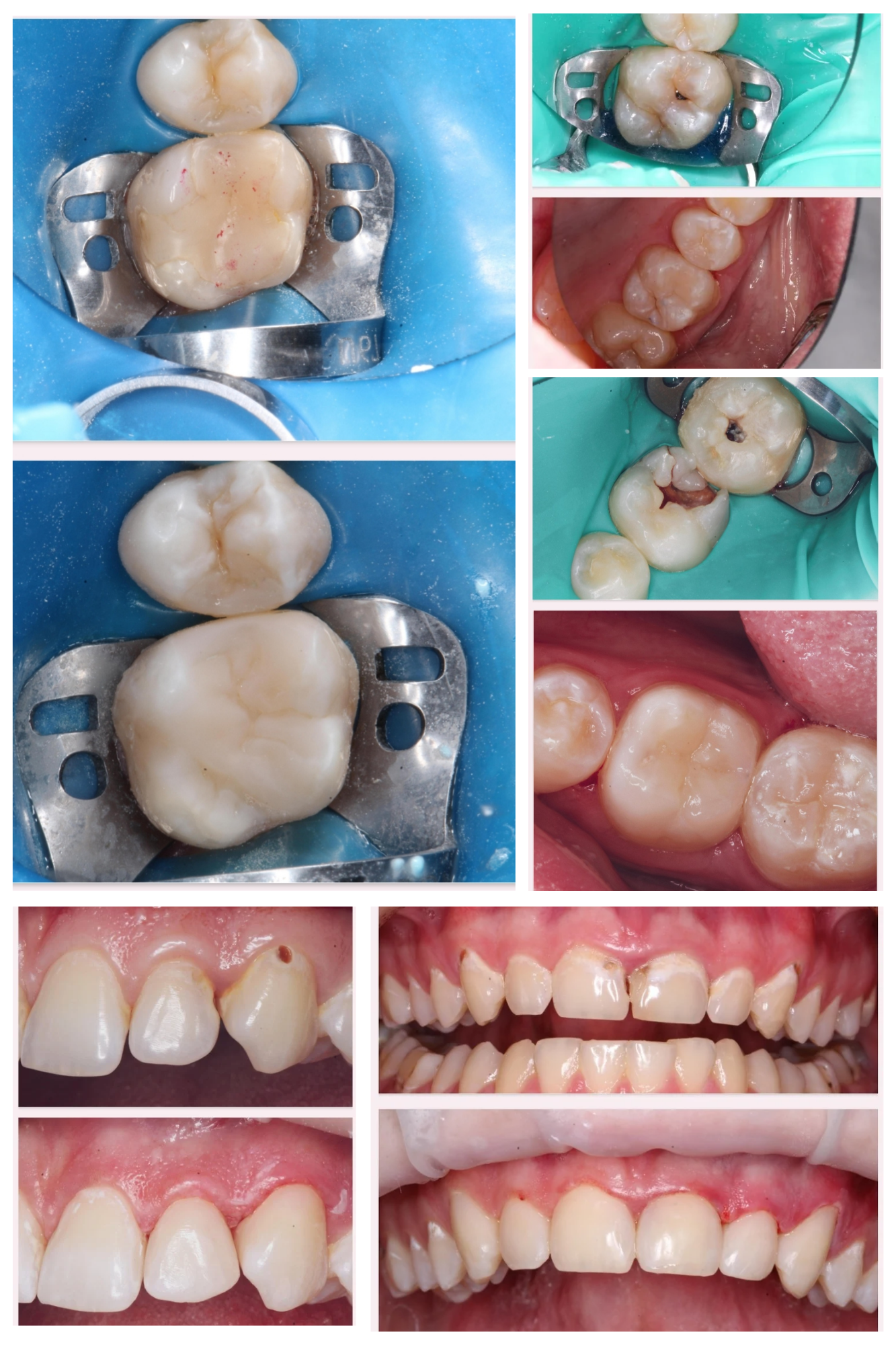 Блог врача. Стоматология «Ортодонт-Эстетик». Установка брекетов в Оренбурге, взрос