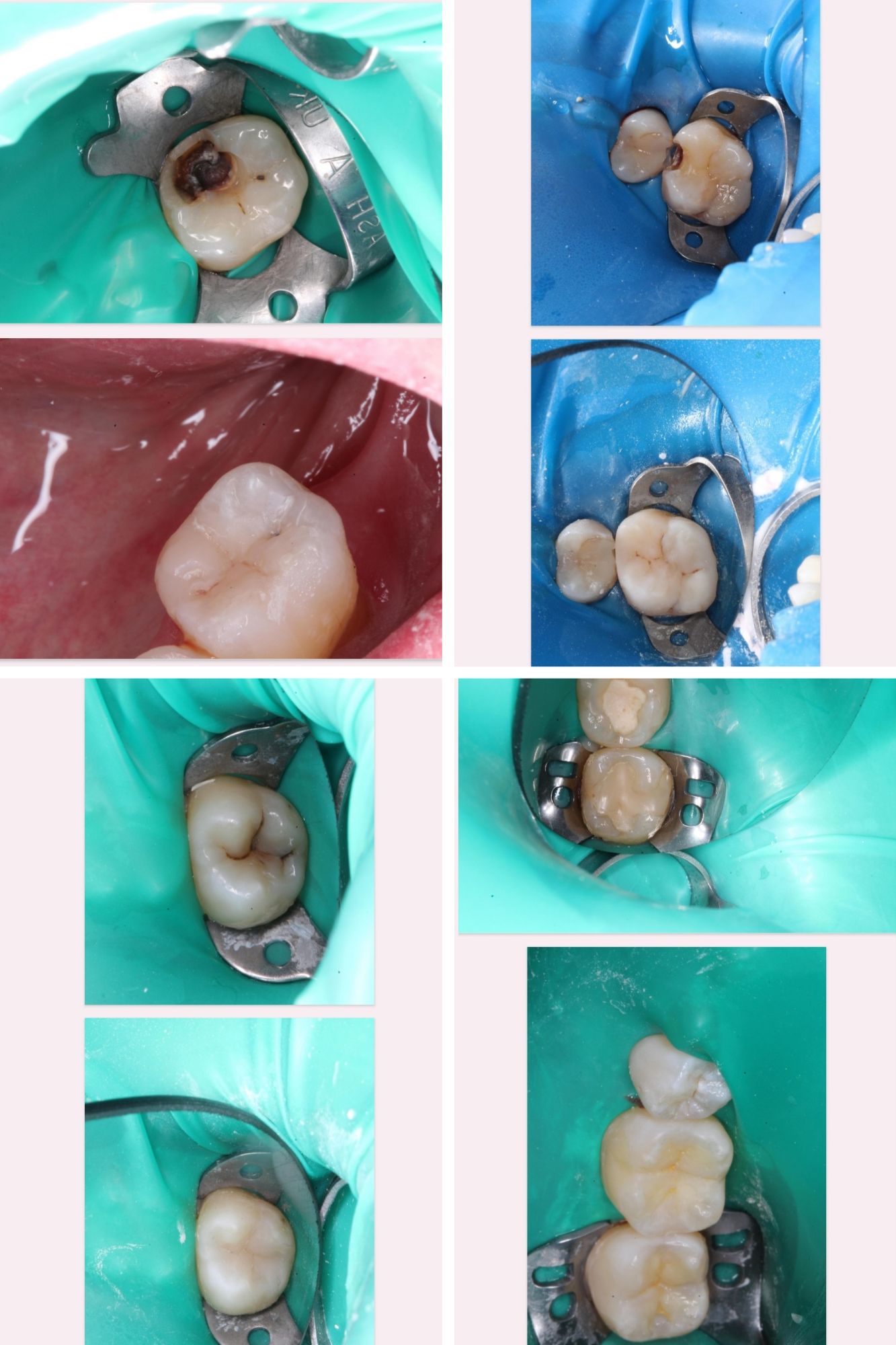 Блог врача. Стоматология «Ортодонт-Эстетик». Установка брекетов в Оренбурге, взрос
