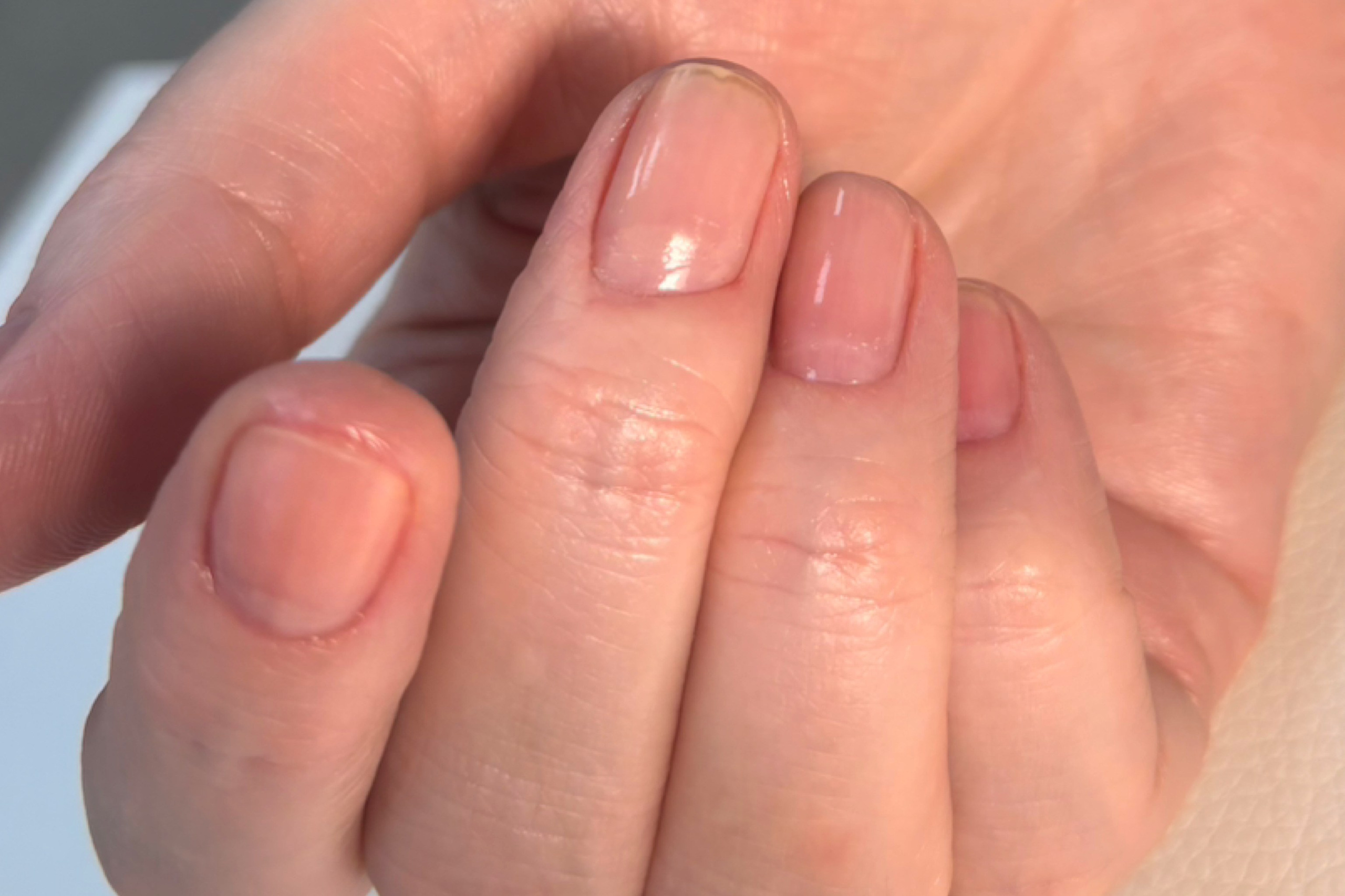 Обработка стопы при грибке. Подолог г. Хабаровск — центр здоровой стопы «FOOTTIME»