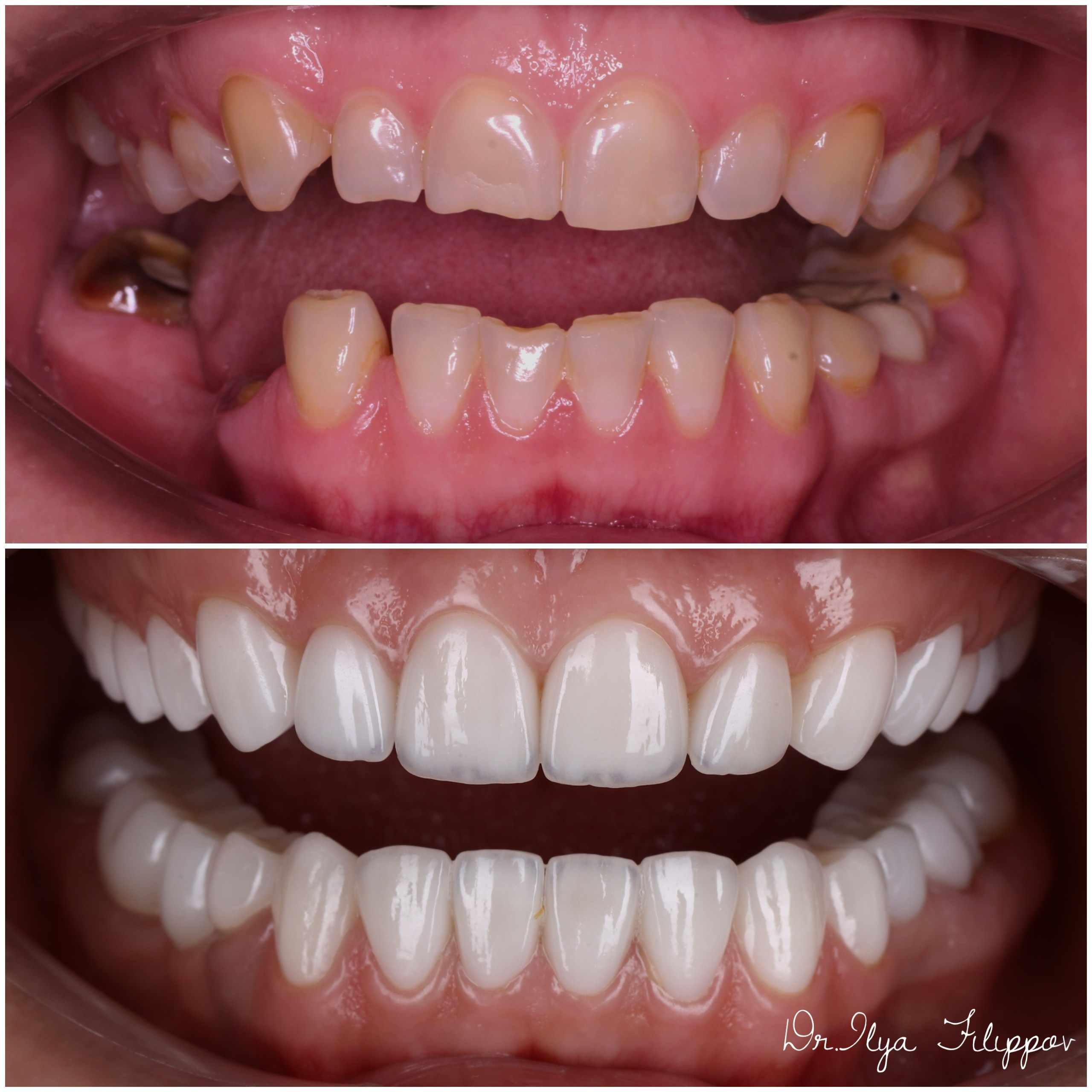 Стоматология в Твери - Линия Улыбки Коронки. Стоматология в Твери - Линия Улыбки