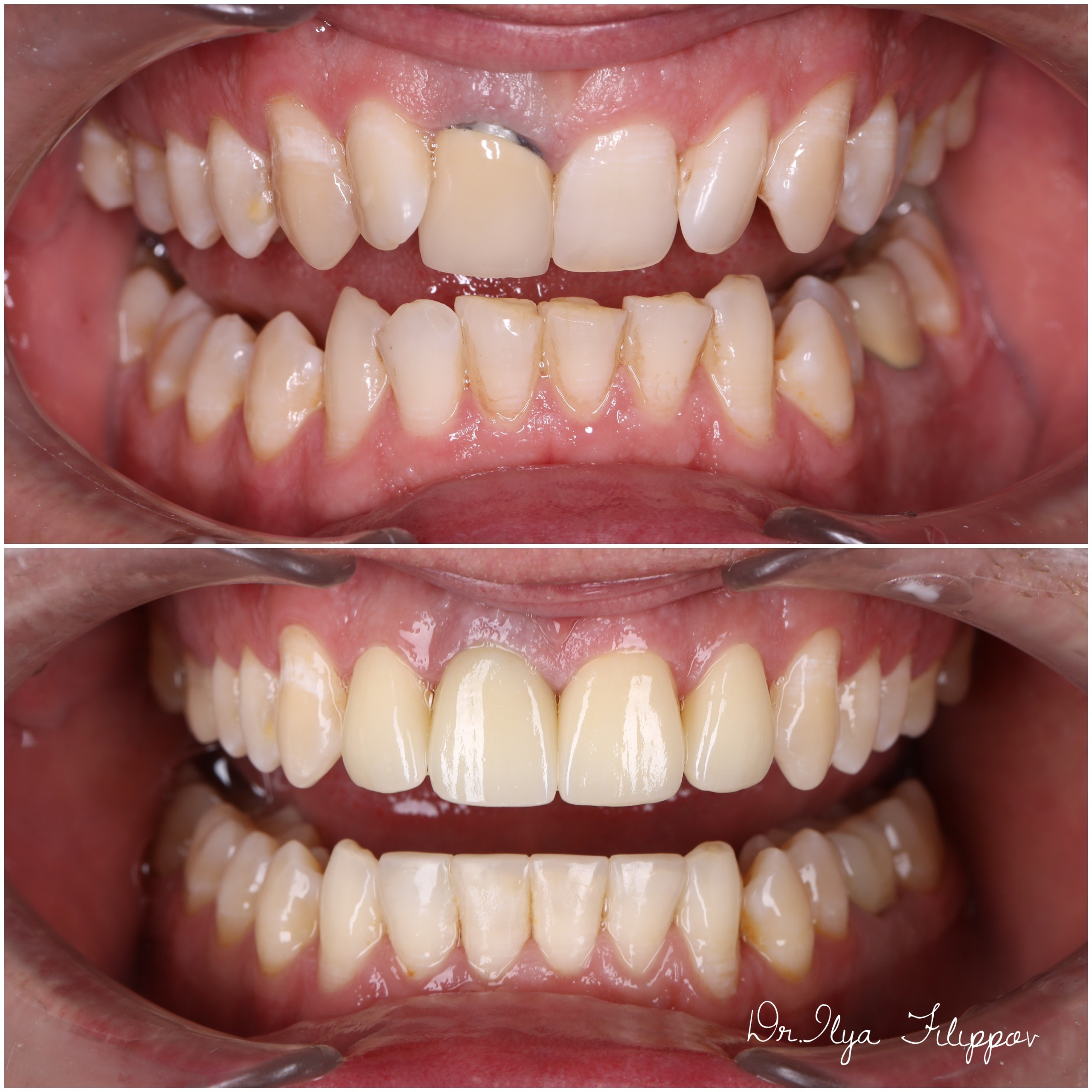 Стоматология в Твери - Линия Улыбки Коронки. Стоматология в Твери - Линия Улыбки