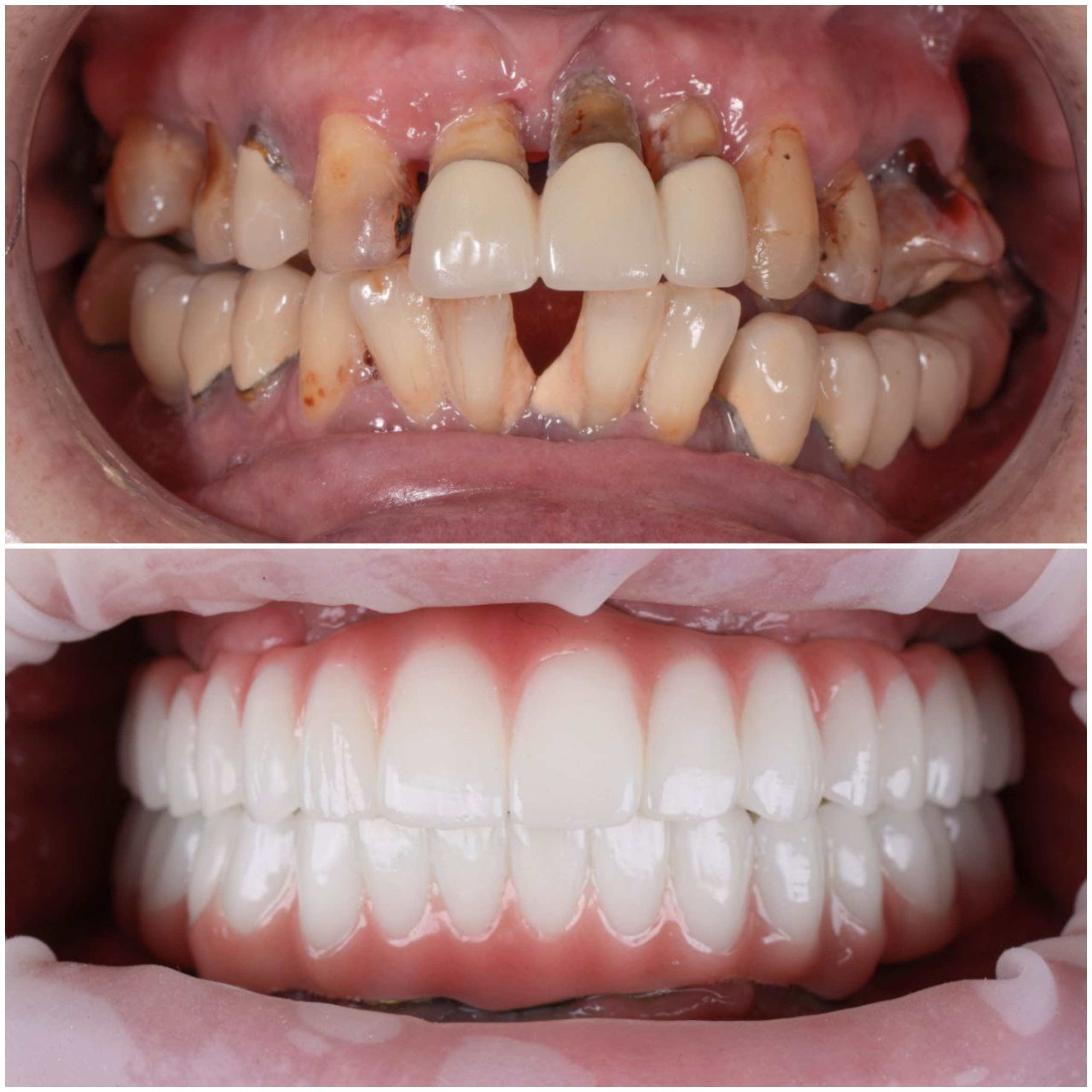 Стоматология в Твери - Линия Улыбки Коронки. Стоматология в Твери - Линия Улыбки