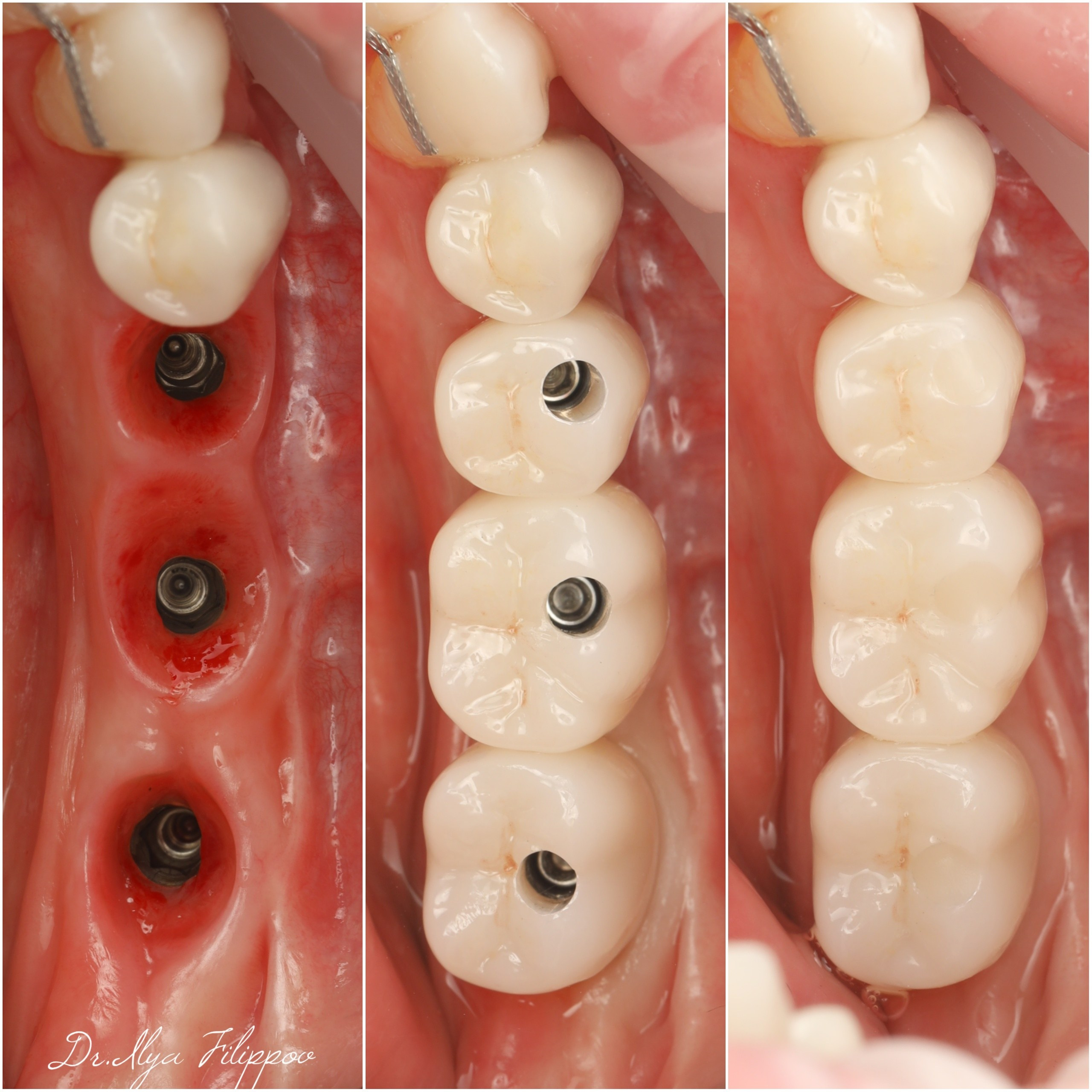 Стоматология в Твери - Линия Улыбки Коронки. Стоматология в Твери - Линия Улыбки