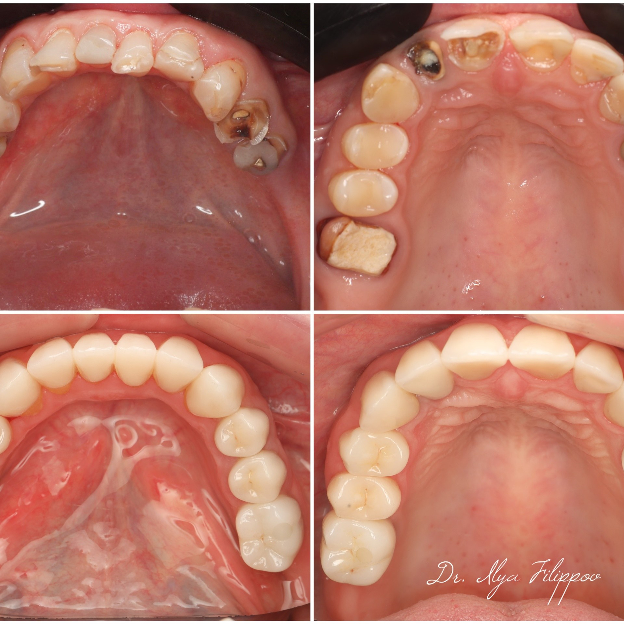 Стоматология в Твери - Линия Улыбки Коронки. Стоматология в Твери - Линия Улыбки