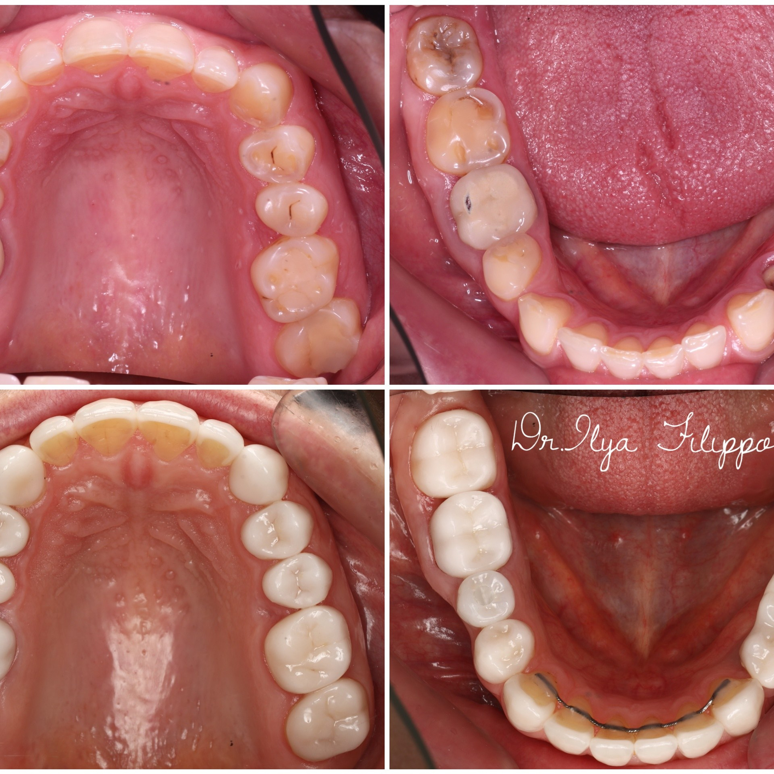Стоматология в Твери - Линия Улыбки Коронки. Стоматология в Твери - Линия Улыбки