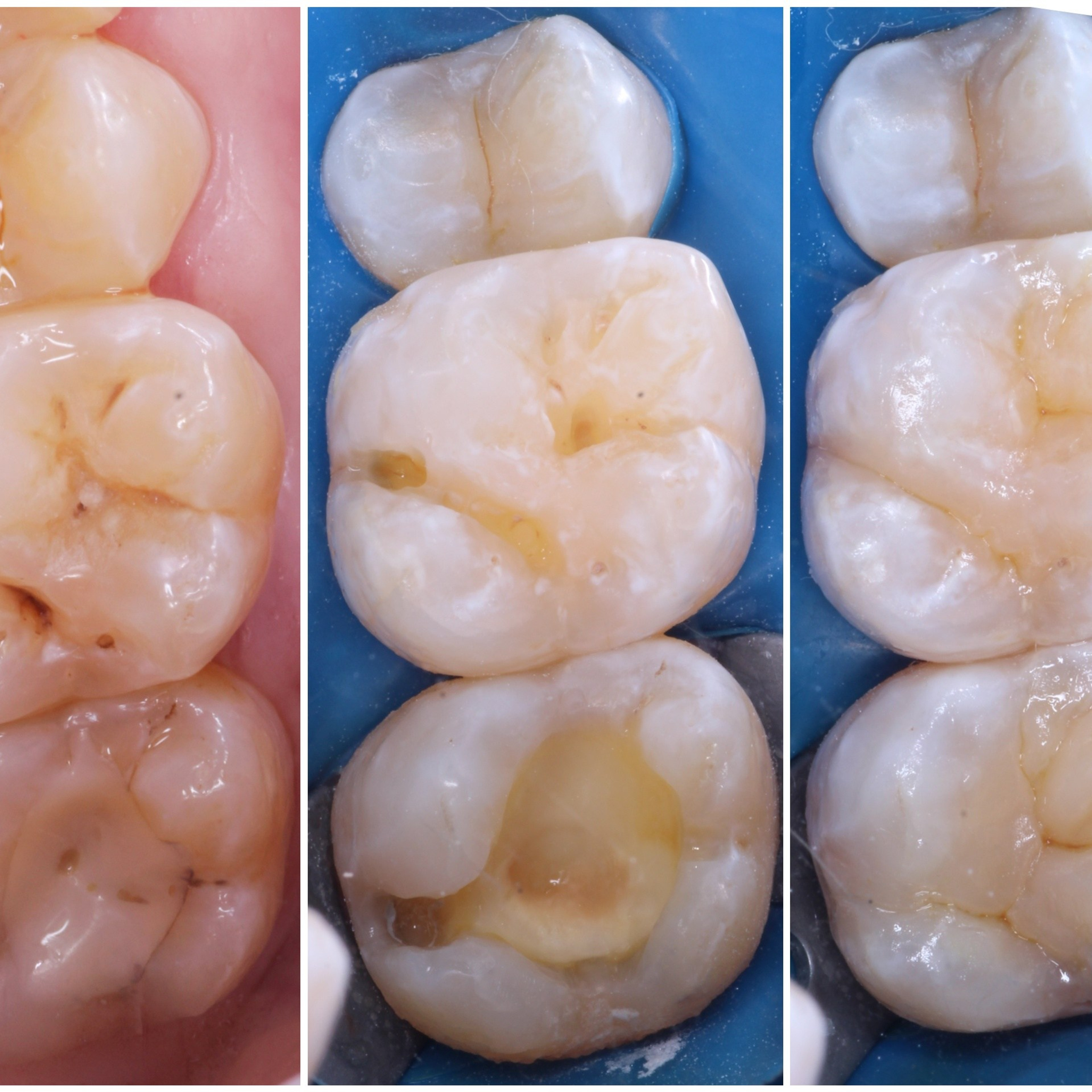 Стоматология в Твери - Линия Улыбки Лечение кариеса. Стоматология в Твери - Линия Улыбки