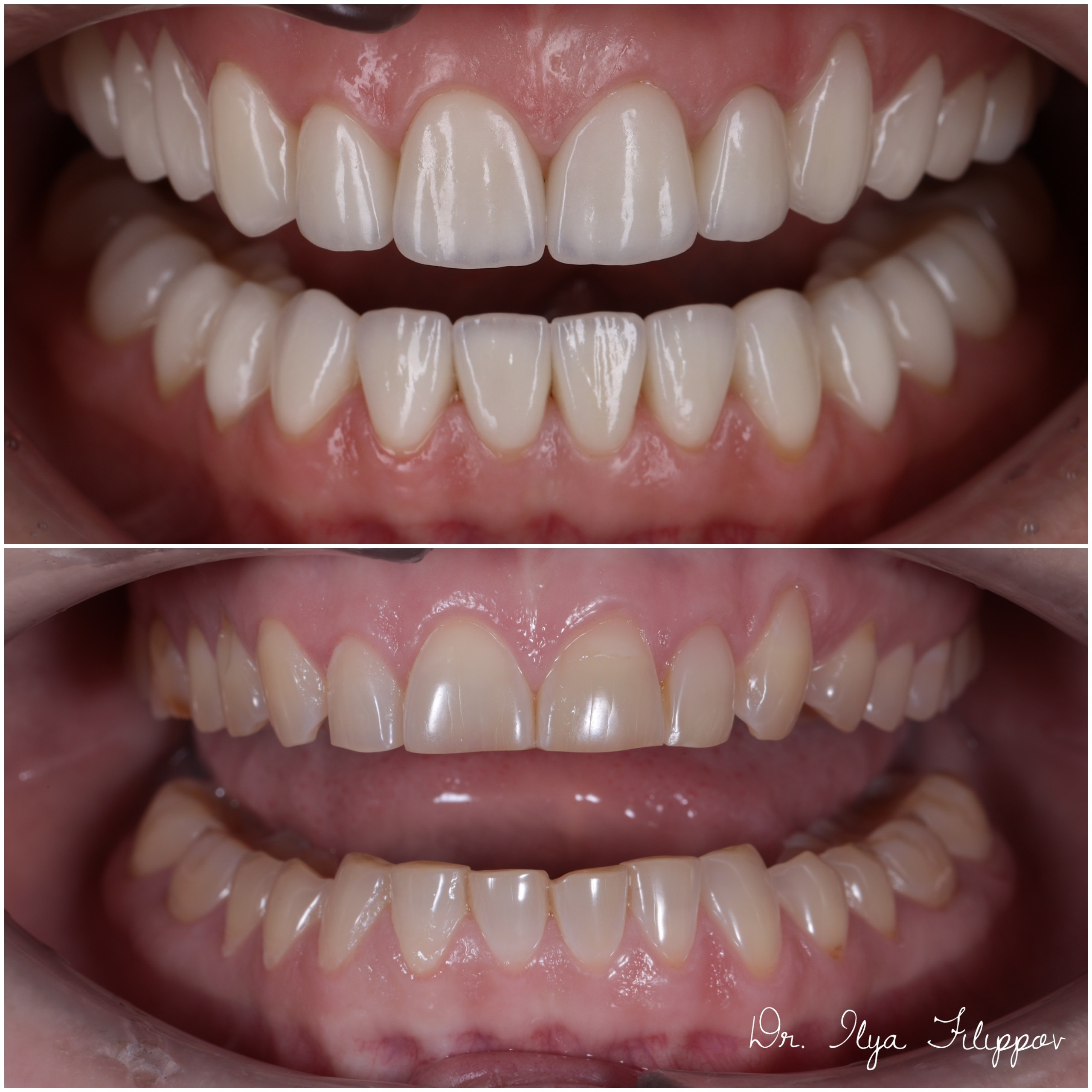 Стоматология в Твери - Линия Улыбки Коронки. Стоматология в Твери - Линия Улыбки