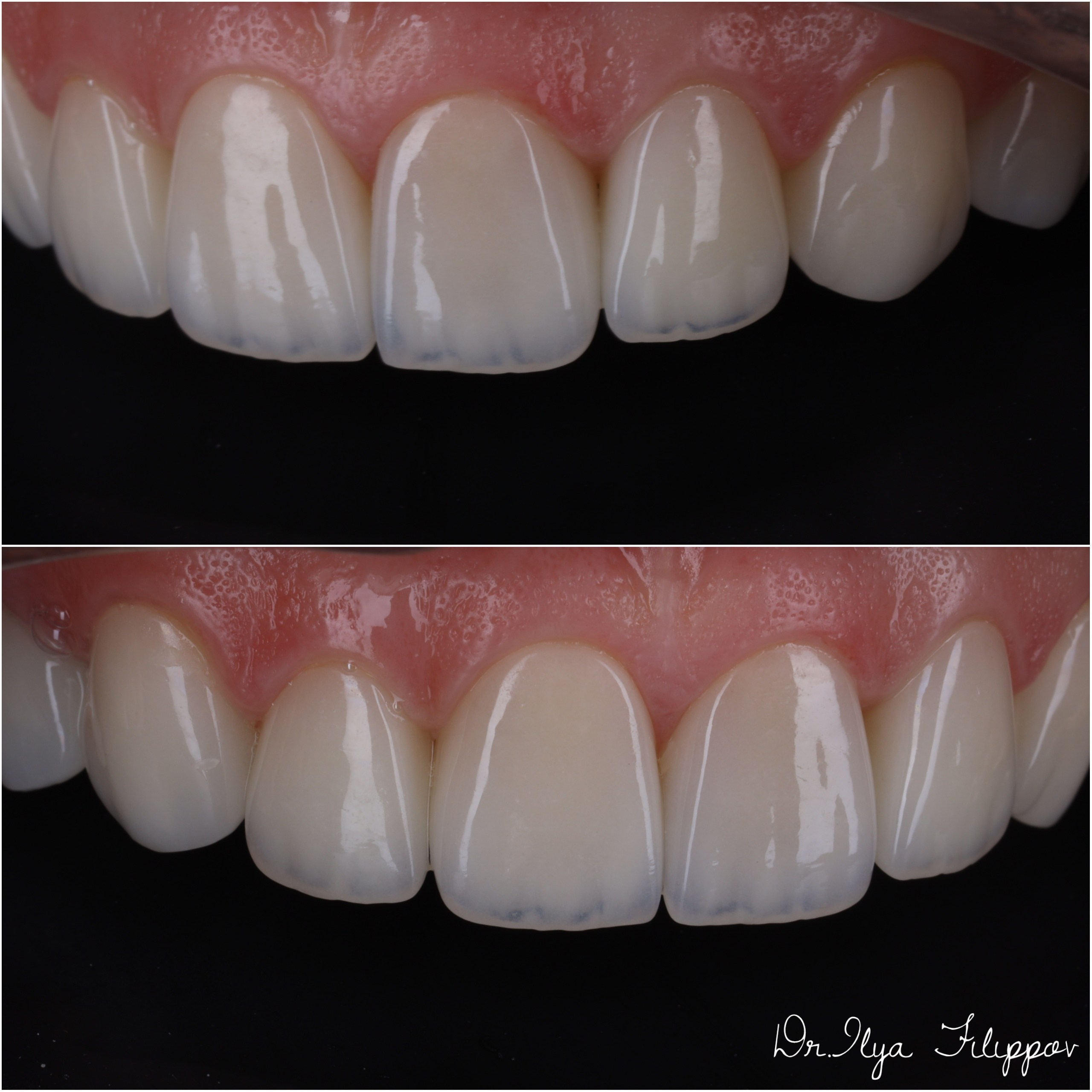 Стоматология в Твери - Линия Улыбки Коронки. Стоматология в Твери - Линия Улыбки