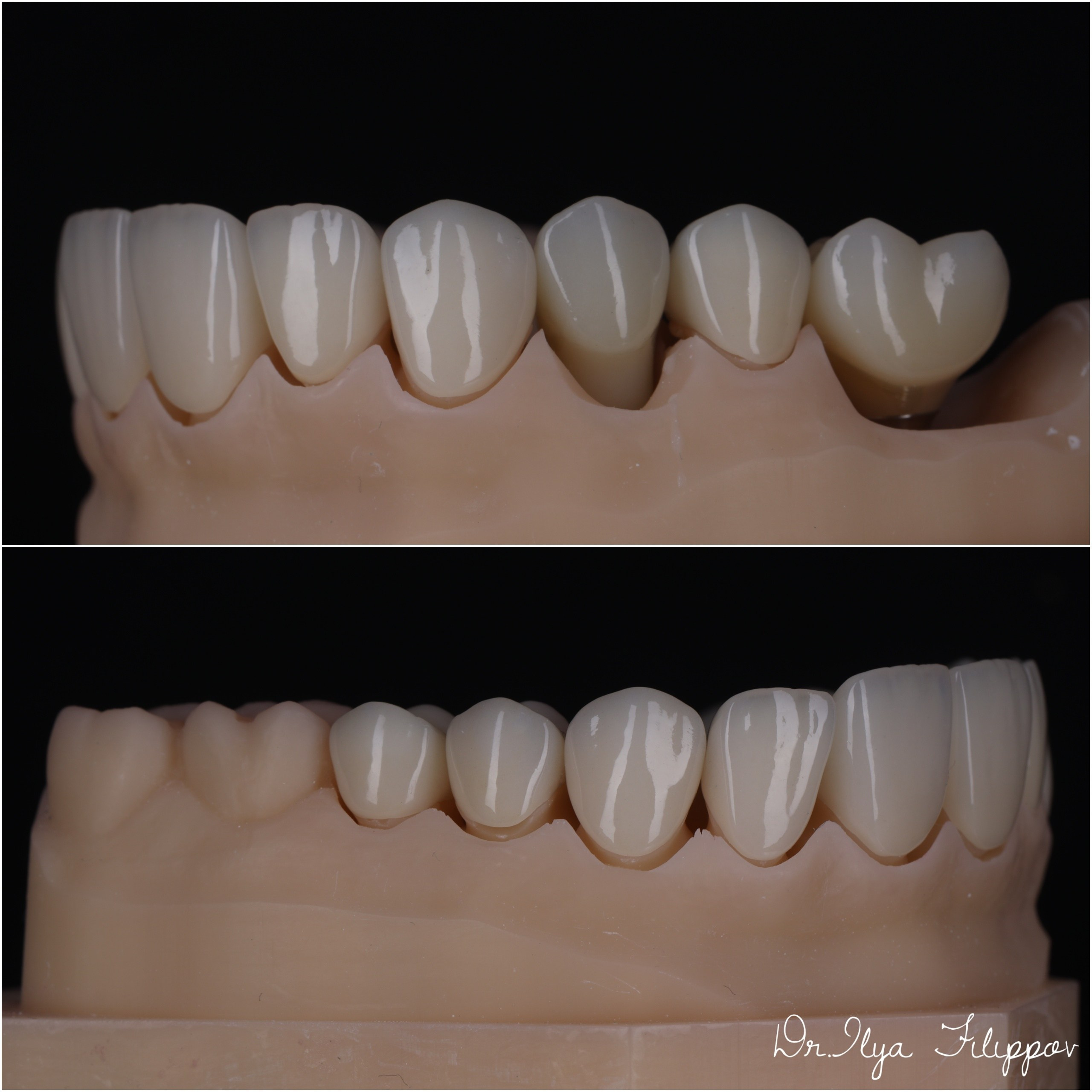 Стоматология в Твери - Линия Улыбки Коронки. Стоматология в Твери - Линия Улыбки