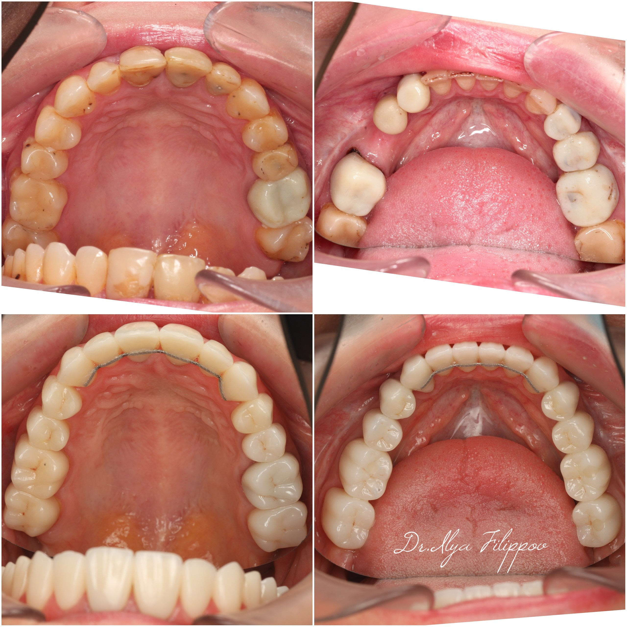 Стоматология в Твери - Линия Улыбки Коронки. Стоматология в Твери - Линия Улыбки