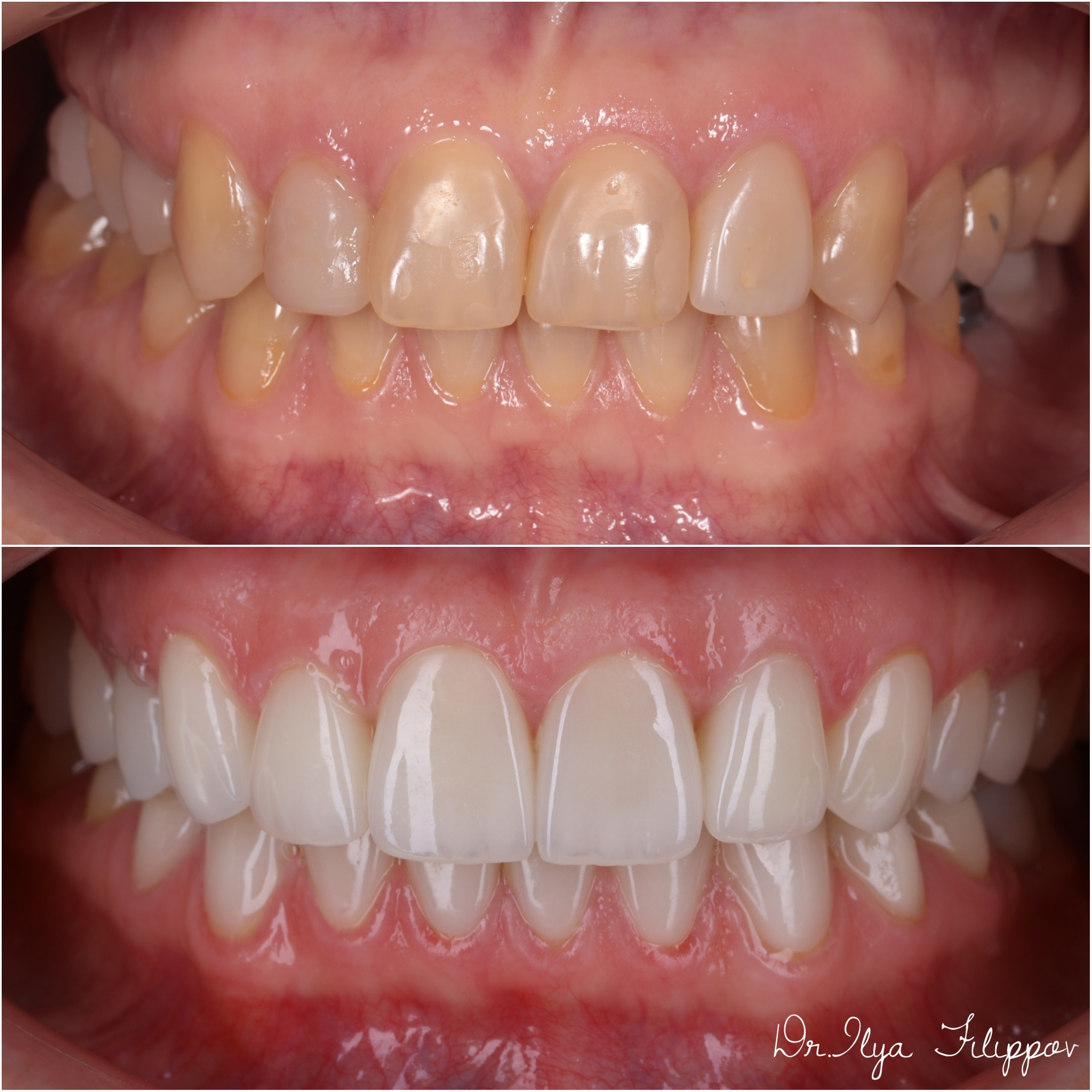 Стоматология в Твери - Линия Улыбки Коронки. Стоматология в Твери - Линия Улыбки