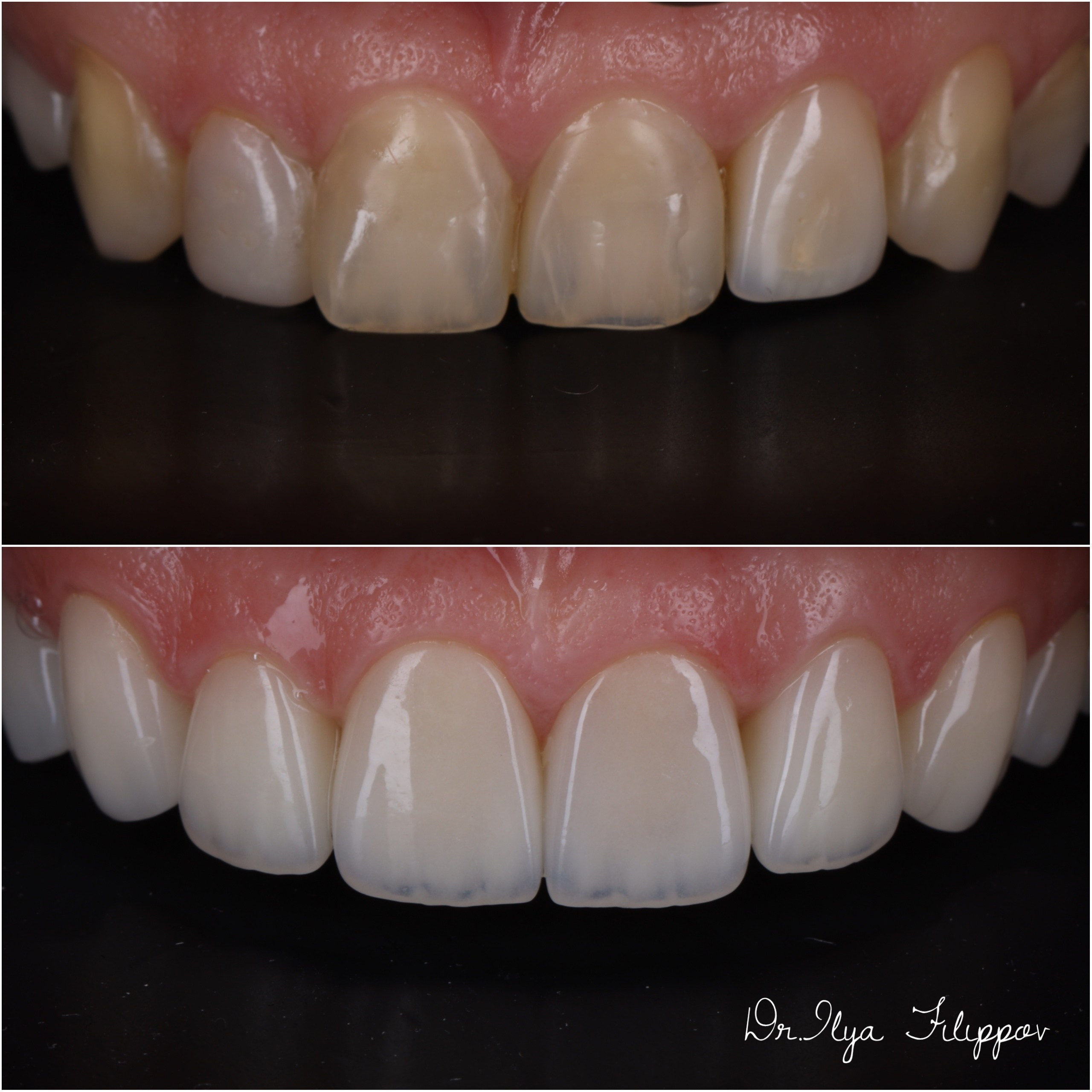 Стоматология в Твери - Линия Улыбки Коронки. Стоматология в Твери - Линия Улыбки