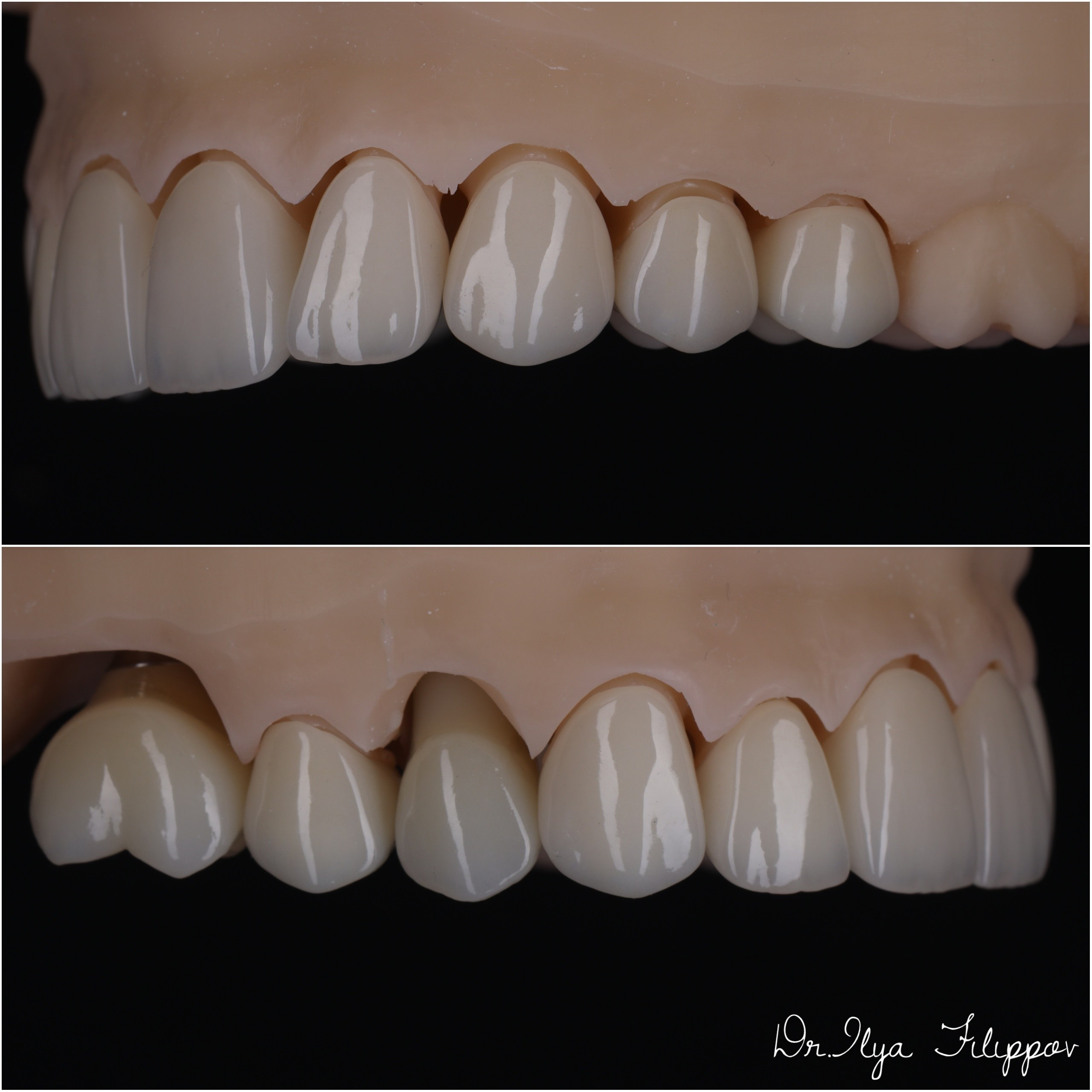 Стоматология в Твери - Линия Улыбки Коронки. Стоматология в Твери - Линия Улыбки