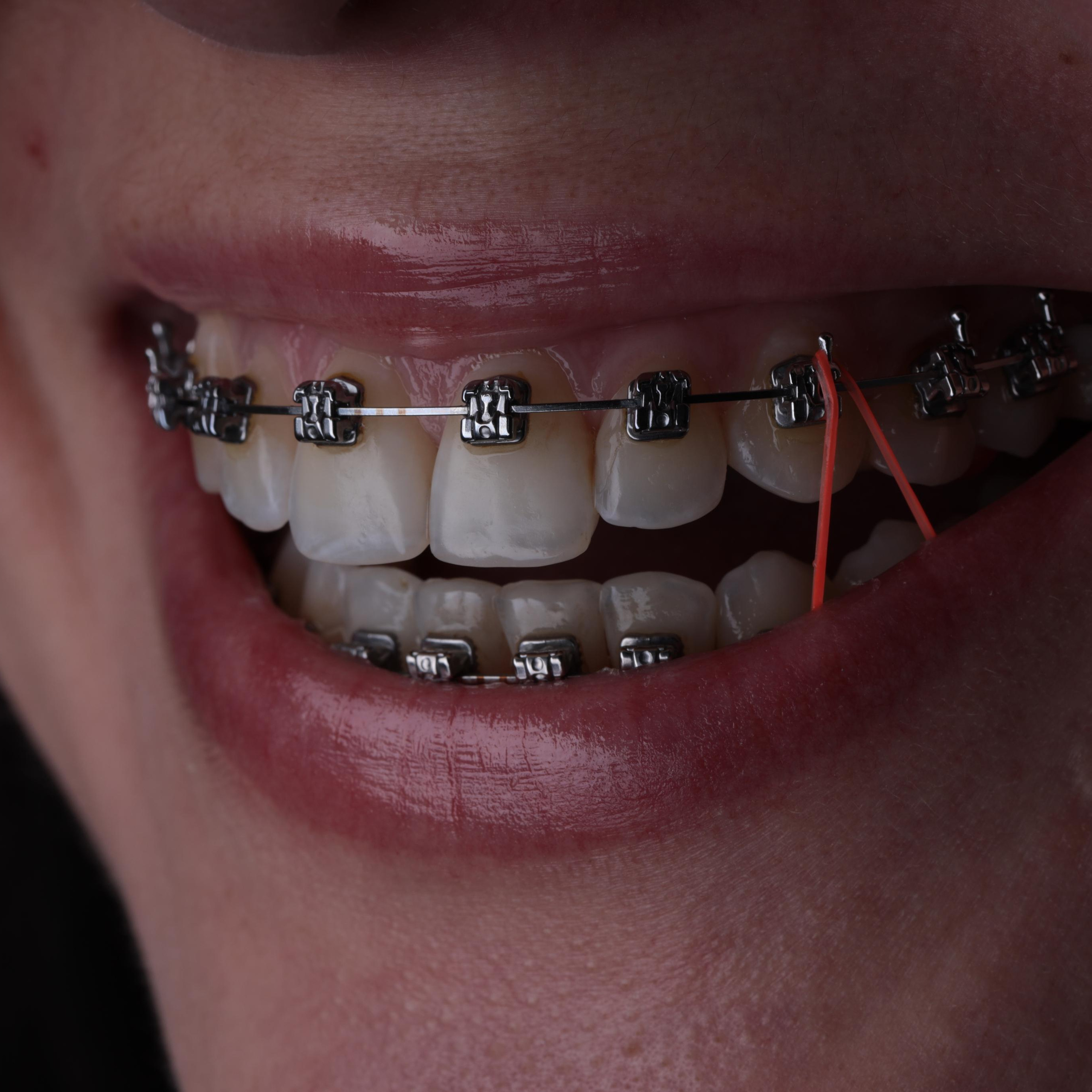 Ортодонтия. Стоматология в Твери - Линия Улыбки