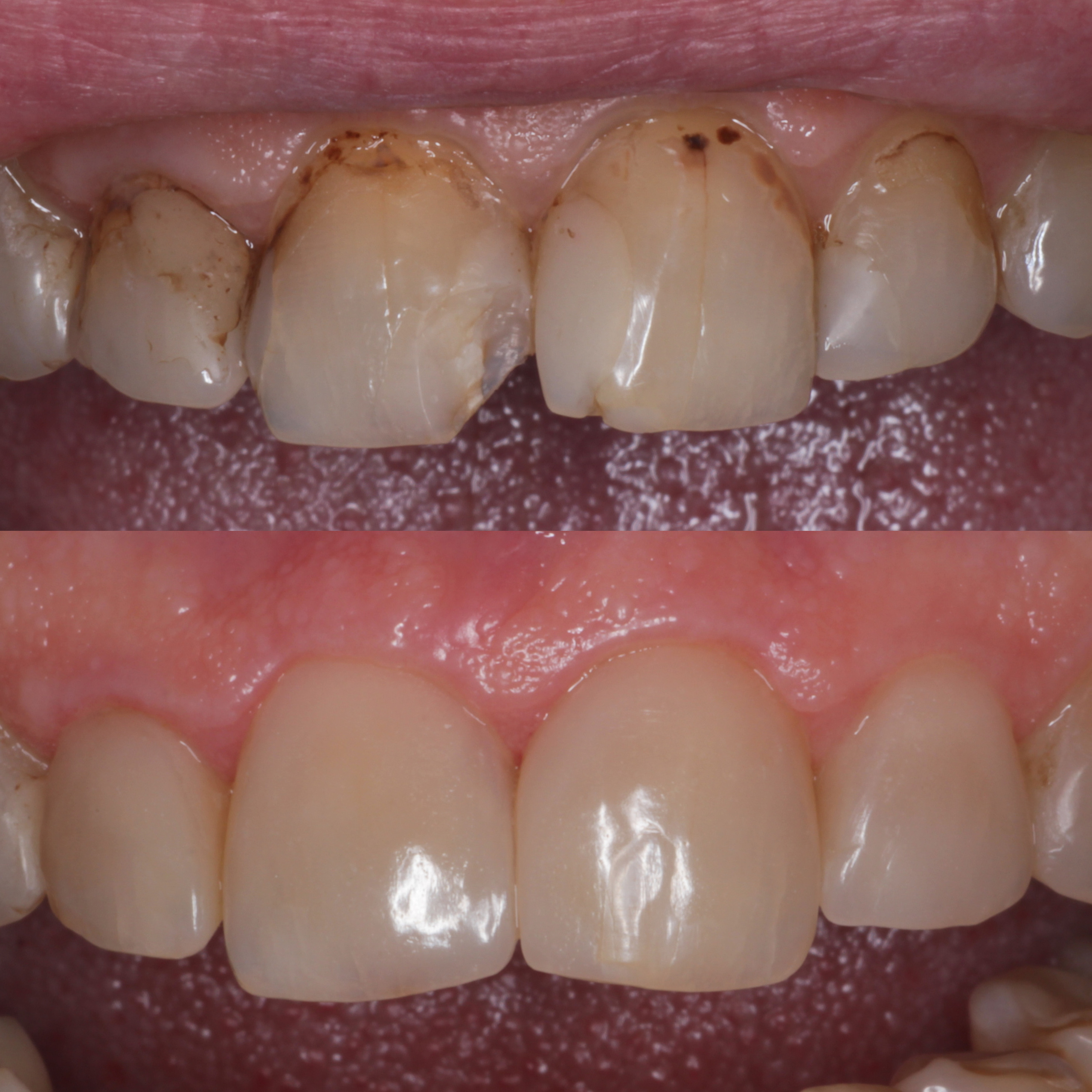 Стоматология в Твери - Линия Улыбки Лечение кариеса. Стоматология в Твери - Линия Улыбки