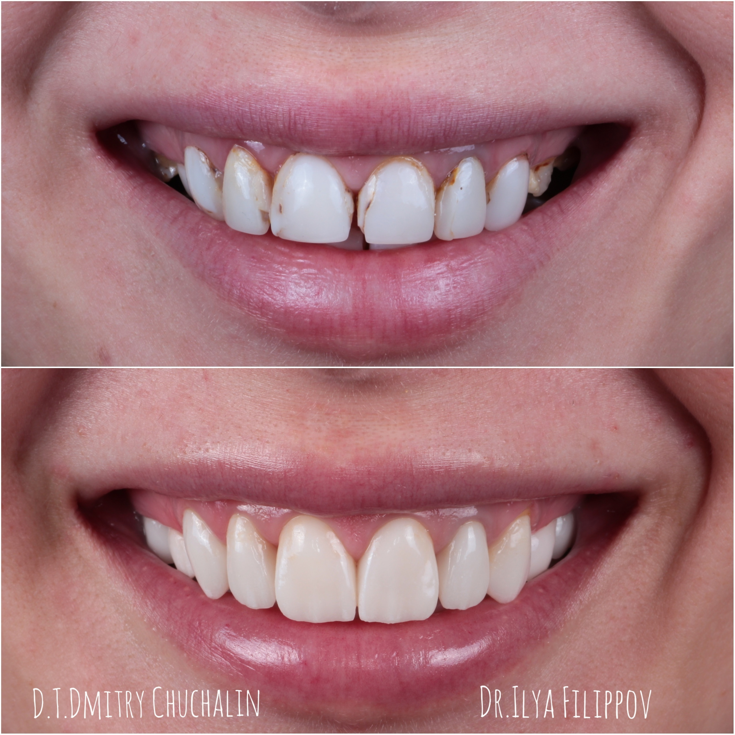 винир,коронка,стоматология,тверь,протезирование зубов,лечение зубов под микроскопом,филиппов илья юрьевич,линия улыбки