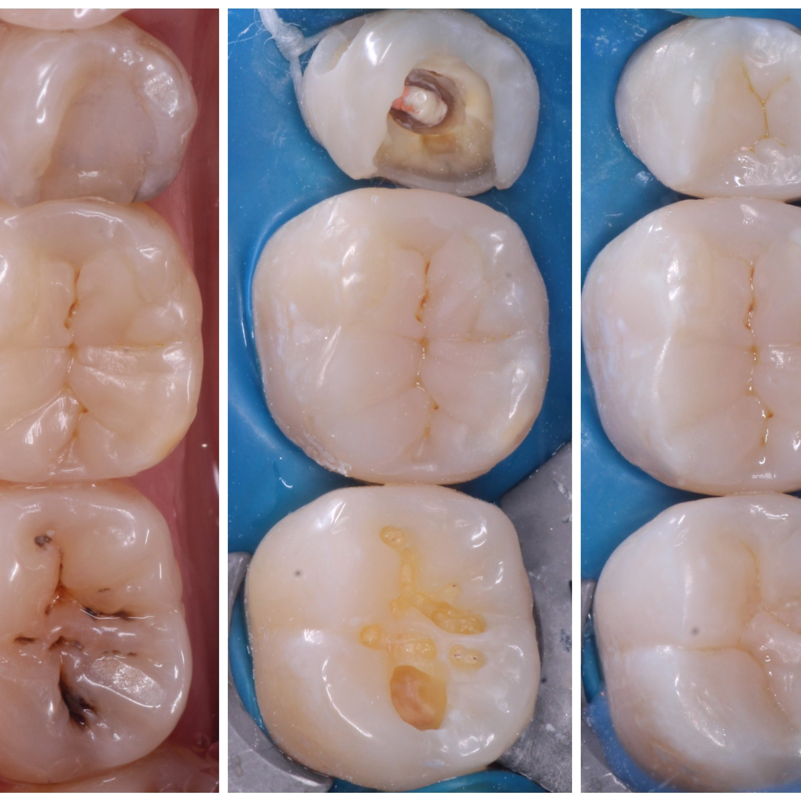 Стоматология в Твери - Линия Улыбки Лечение кариеса. Стоматология в Твери - Линия Улыбки