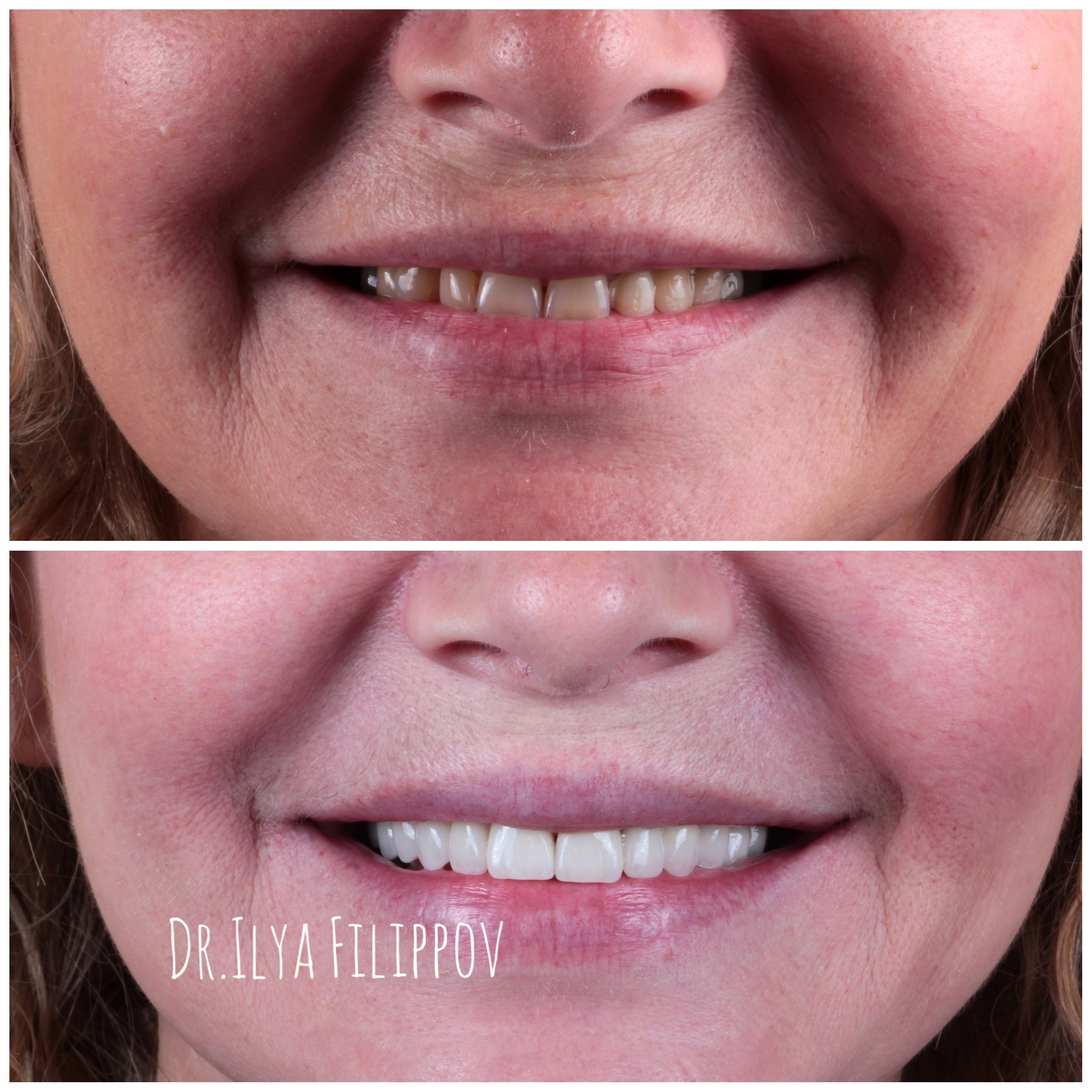 Стоматология в Твери - Линия Улыбки Коронки. Стоматология в Твери - Линия Улыбки