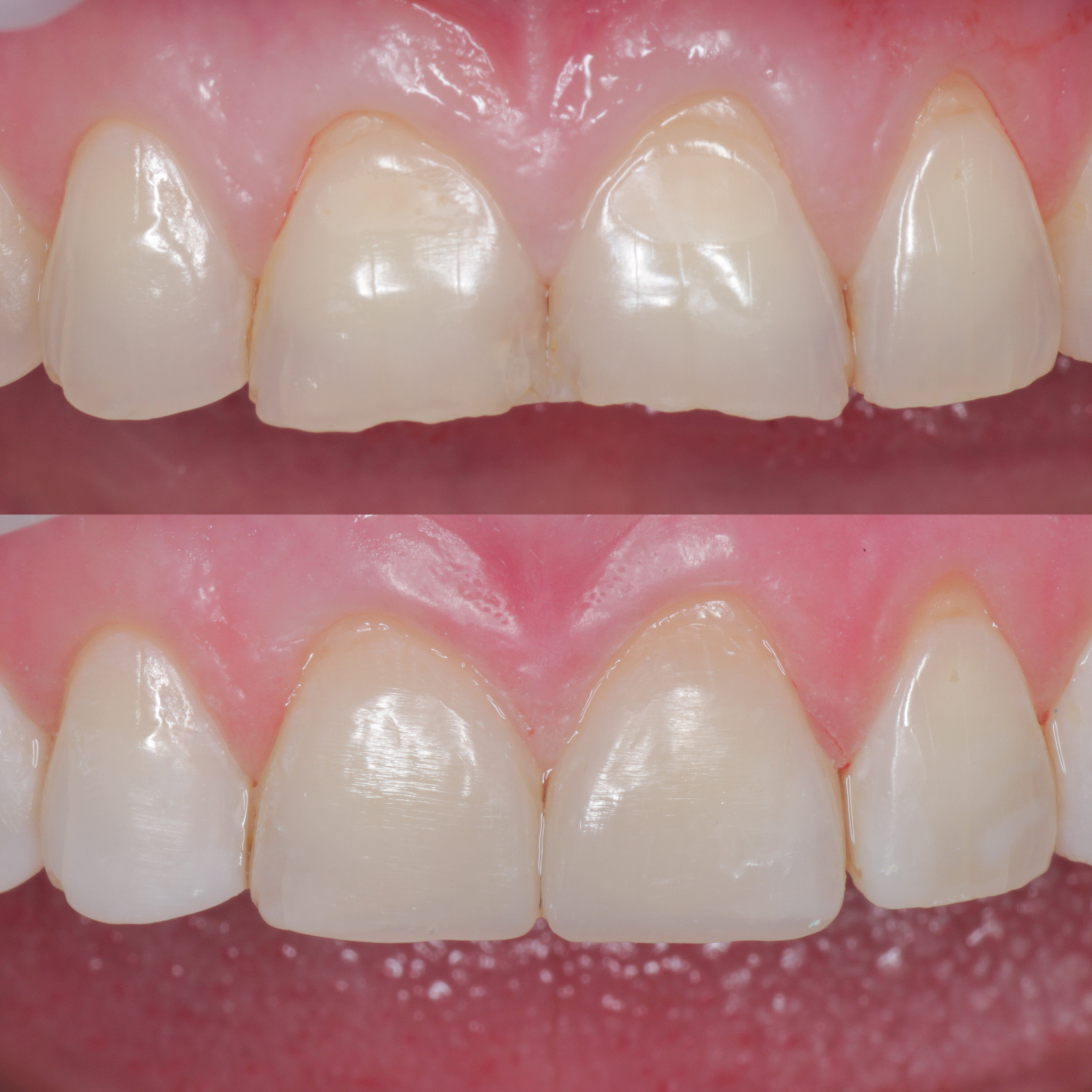 Стоматология в Твери - Линия Улыбки Лечение кариеса. Стоматология в Твери - Линия Улыбки