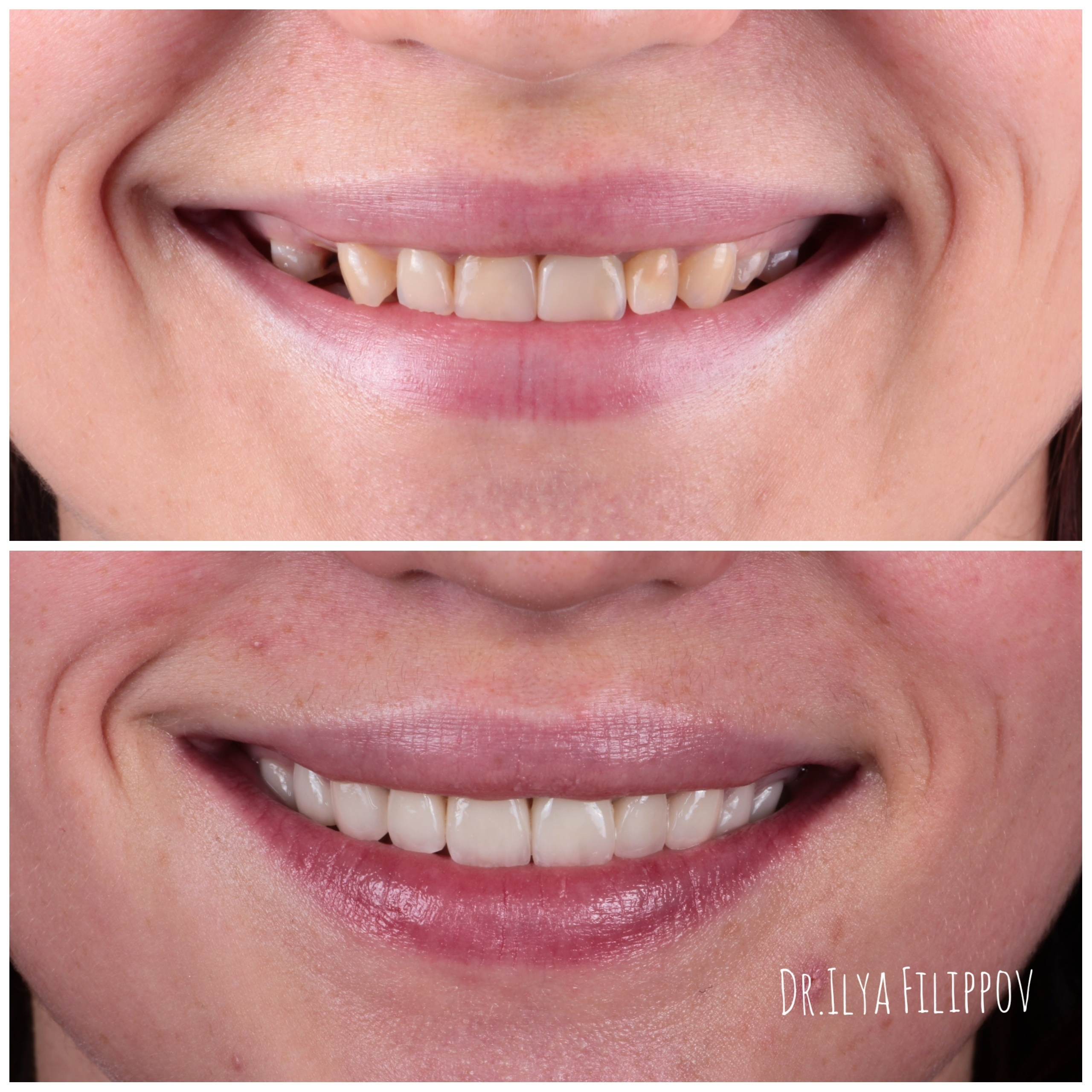 винир,коронка,стоматология,тверь,протезирование зубов,лечение зубов под микроскопом,филиппов илья юрьевич,линия улыбки