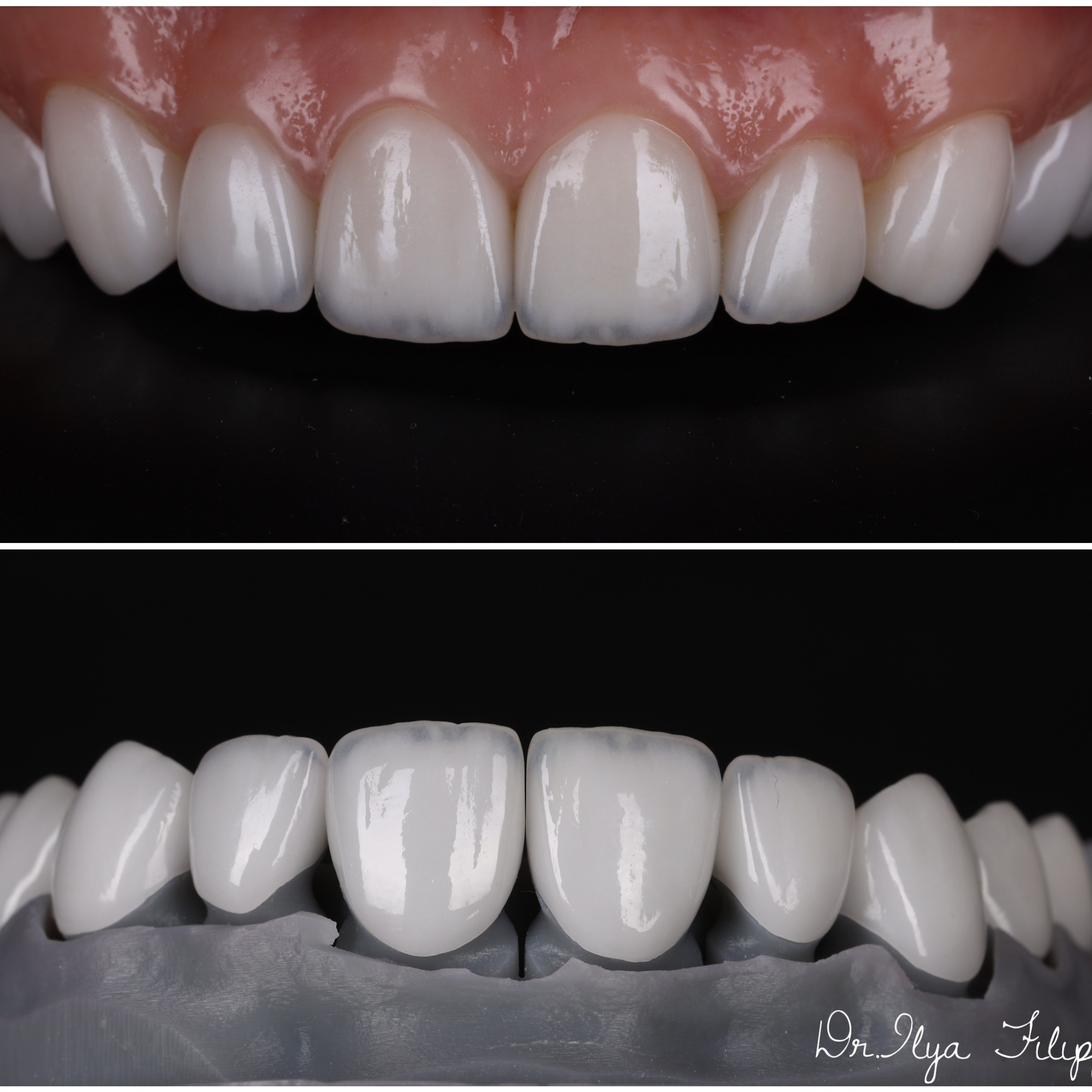 Стоматология в Твери - Линия Улыбки Коронки. Стоматология в Твери - Линия Улыбки