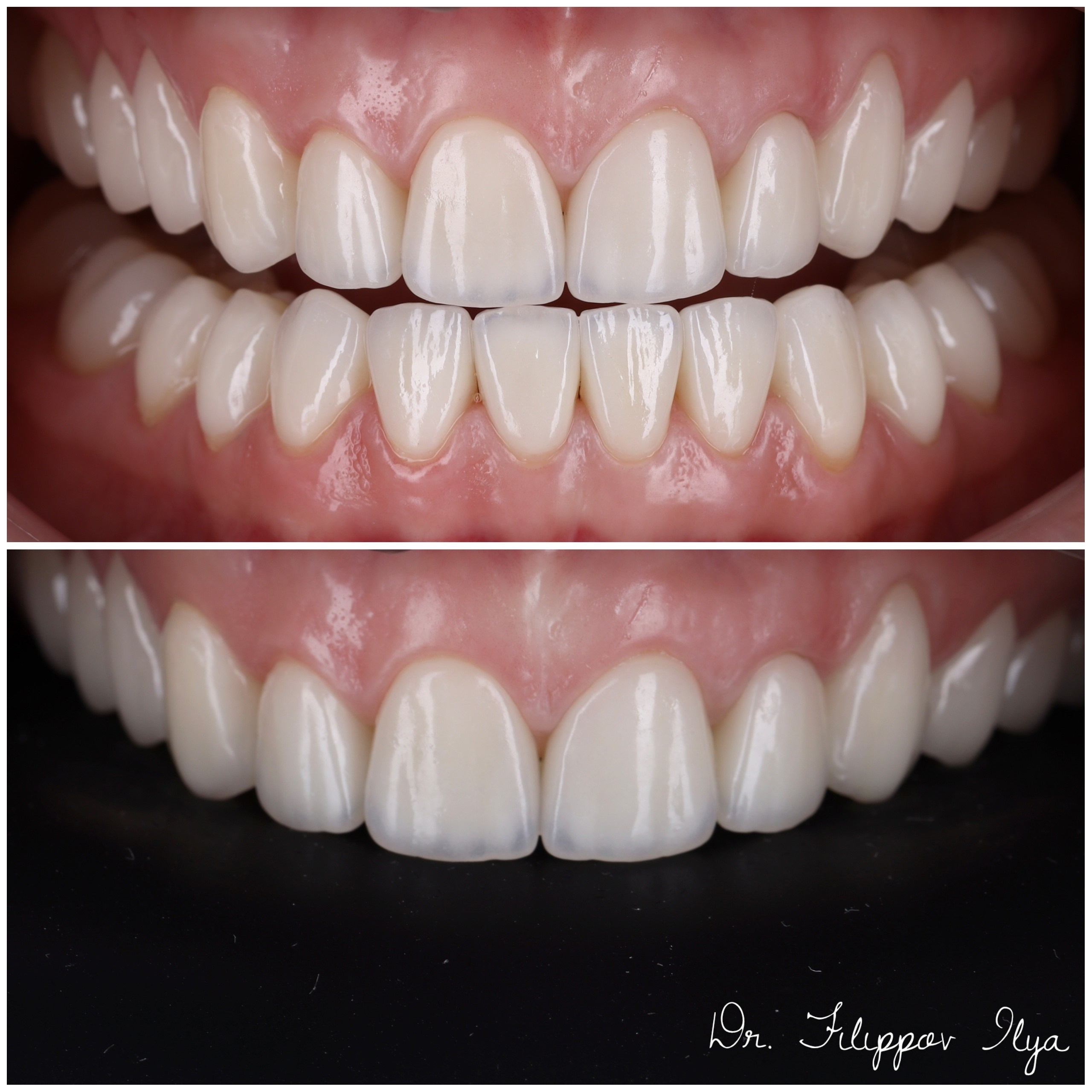 Стоматология в Твери - Линия Улыбки Коронки. Стоматология в Твери - Линия Улыбки