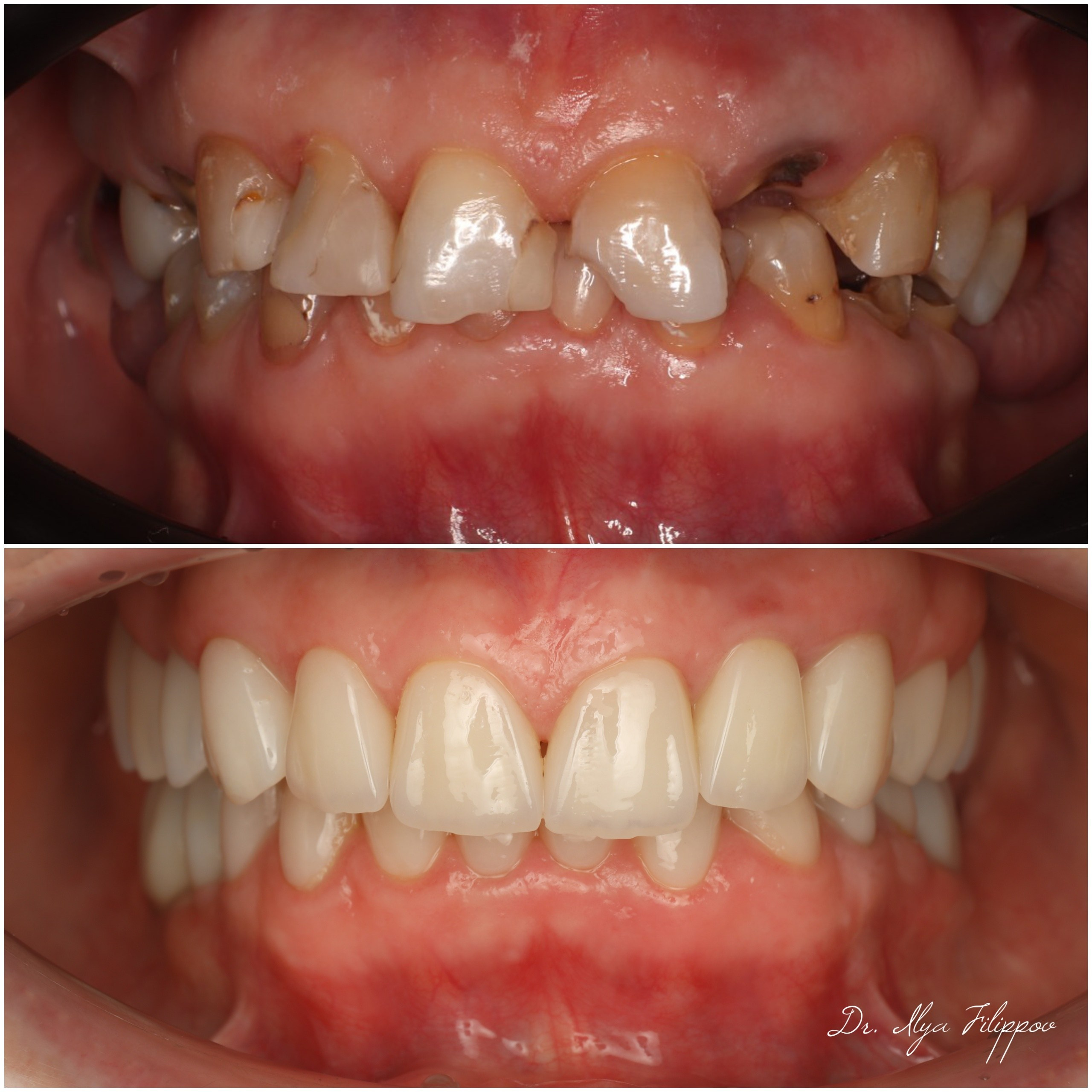 Стоматология в Твери - Линия Улыбки Коронки. Стоматология в Твери - Линия Улыбки