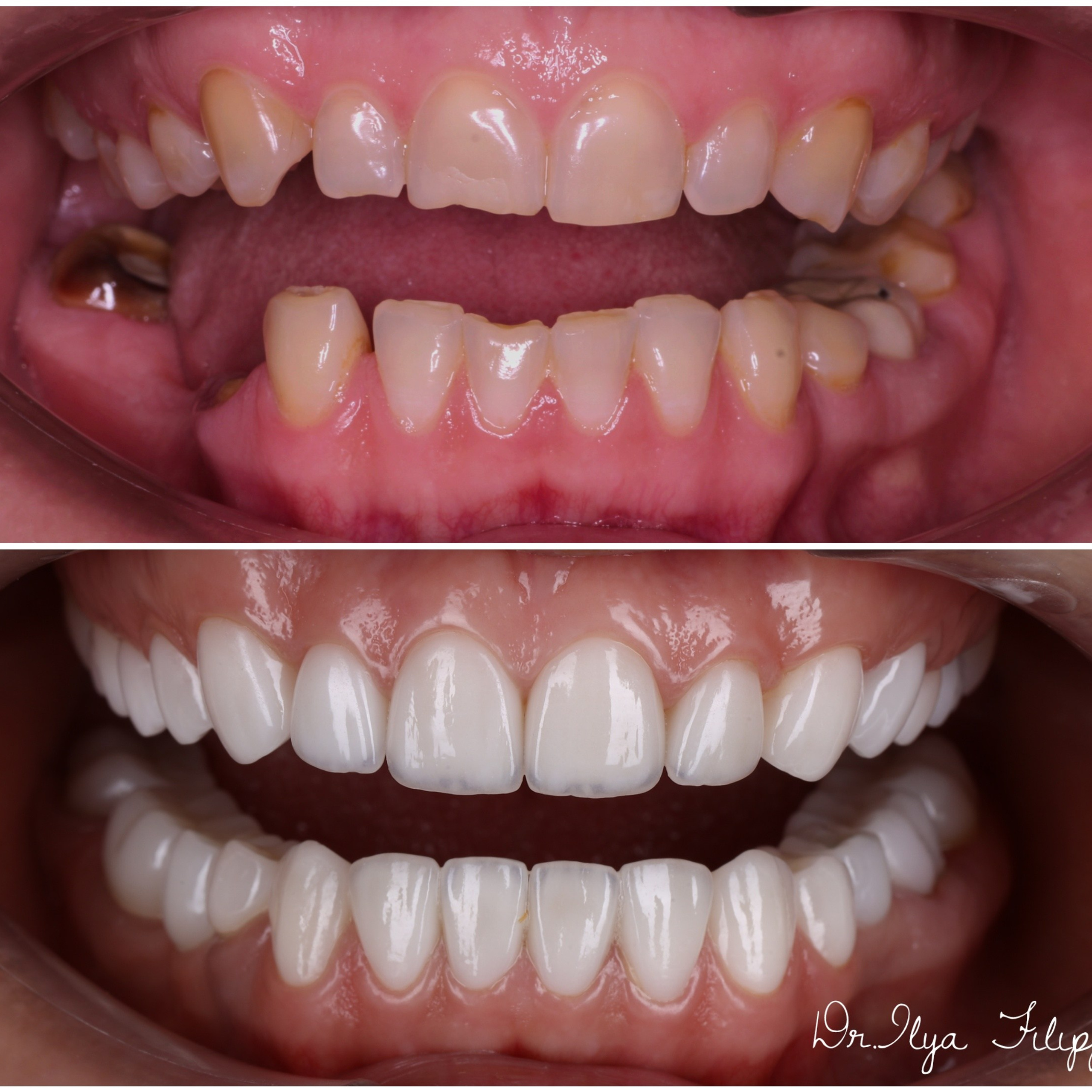 Стоматология в Твери - Линия Улыбки Коронки. Стоматология в Твери - Линия Улыбки