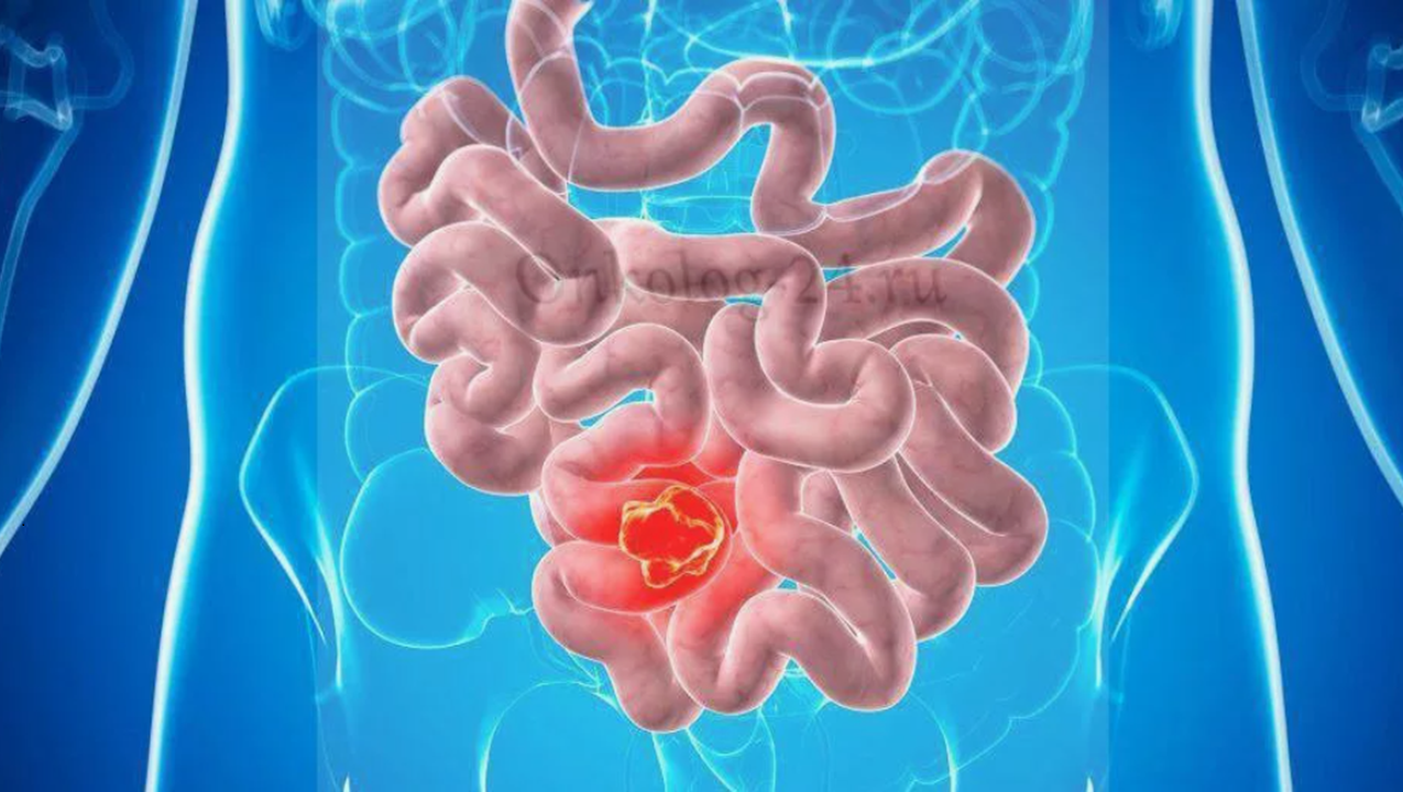 Какие препараты компании Сово-Сова помогут при раке тонкого кишечника. 
