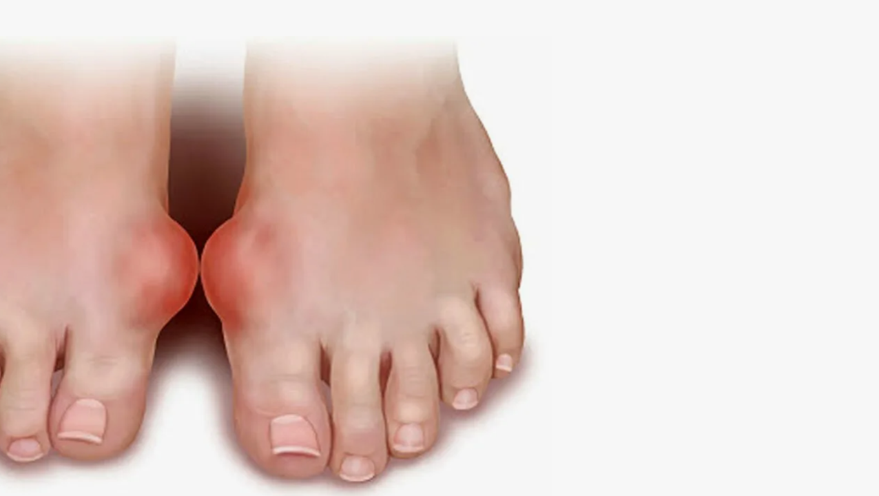 Препараты компании Сово-Сова, которые помогают при подагре. Чем лечить подагру