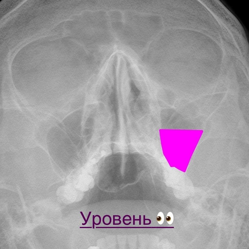 Разбираемся с пазухами на рентгене. Первые шаги. РЕНТГЕН КТ МРТ в Санкт-Петербурге Александра Лоншакова