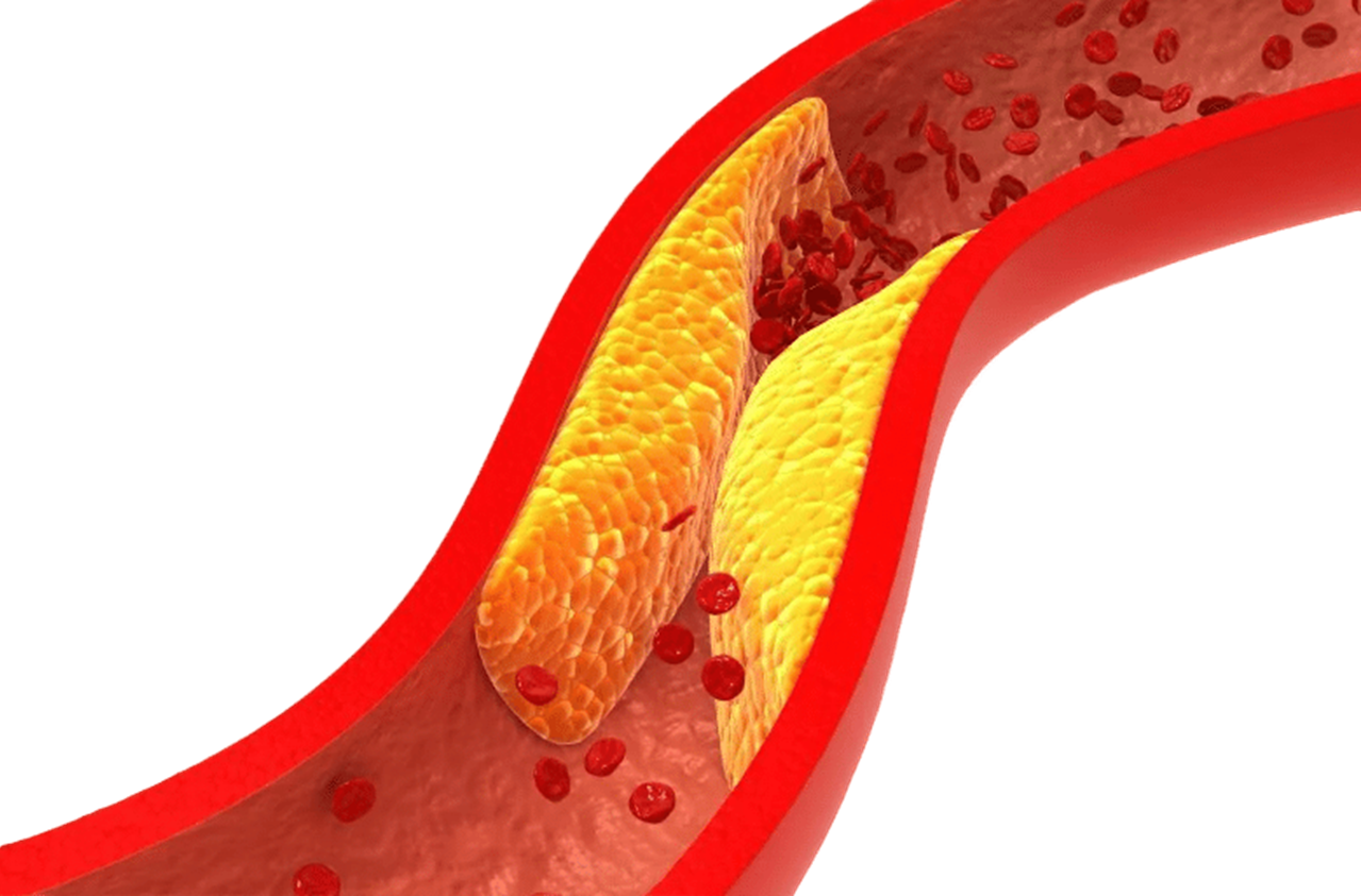 Чем опасен повышенный холестерин. Сово-Сово — Омоложение и оздоровление!