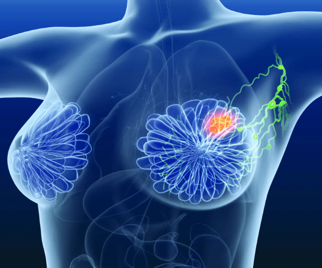 Рак молочной железы. Возможные причины. Диагностика. Лечение. Сово-Сово — Омоложение и оздоровление!