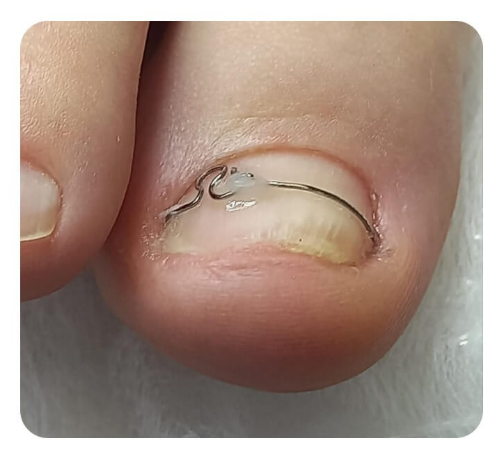 Услуги и цены подолога в Хабаровске, цены на педикюр Хабаровск. Подолог г. Хабаровск — центр здоровой стопы «FOOTTIME»