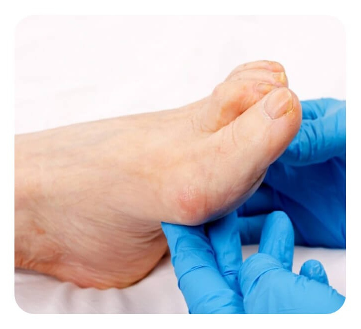 Уход за диабетической стопой