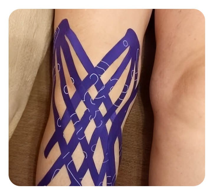 Тейпирование стопы