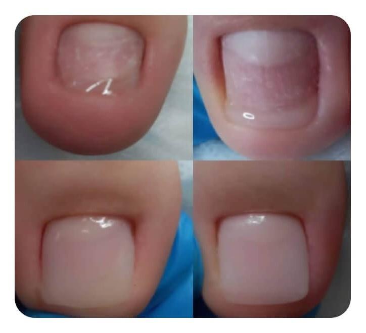 Протезирование ногтей