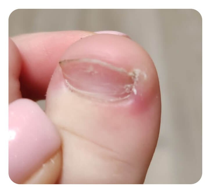 Лечение вросшего ногтя