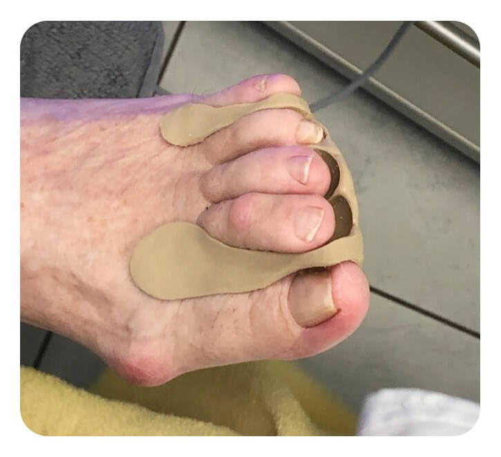 Изготовление ортозов