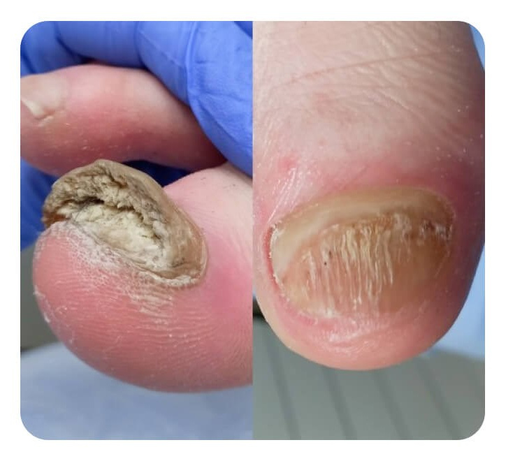 Лечение грибка ногтя