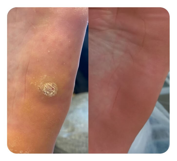 Удаление бородавок