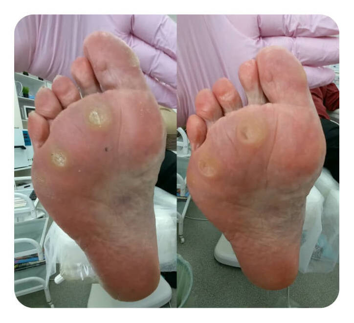 Удаление мозолей и натоптышей