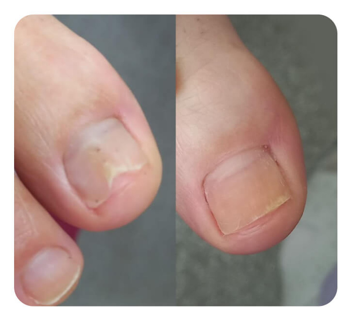 Восстановление ногтей